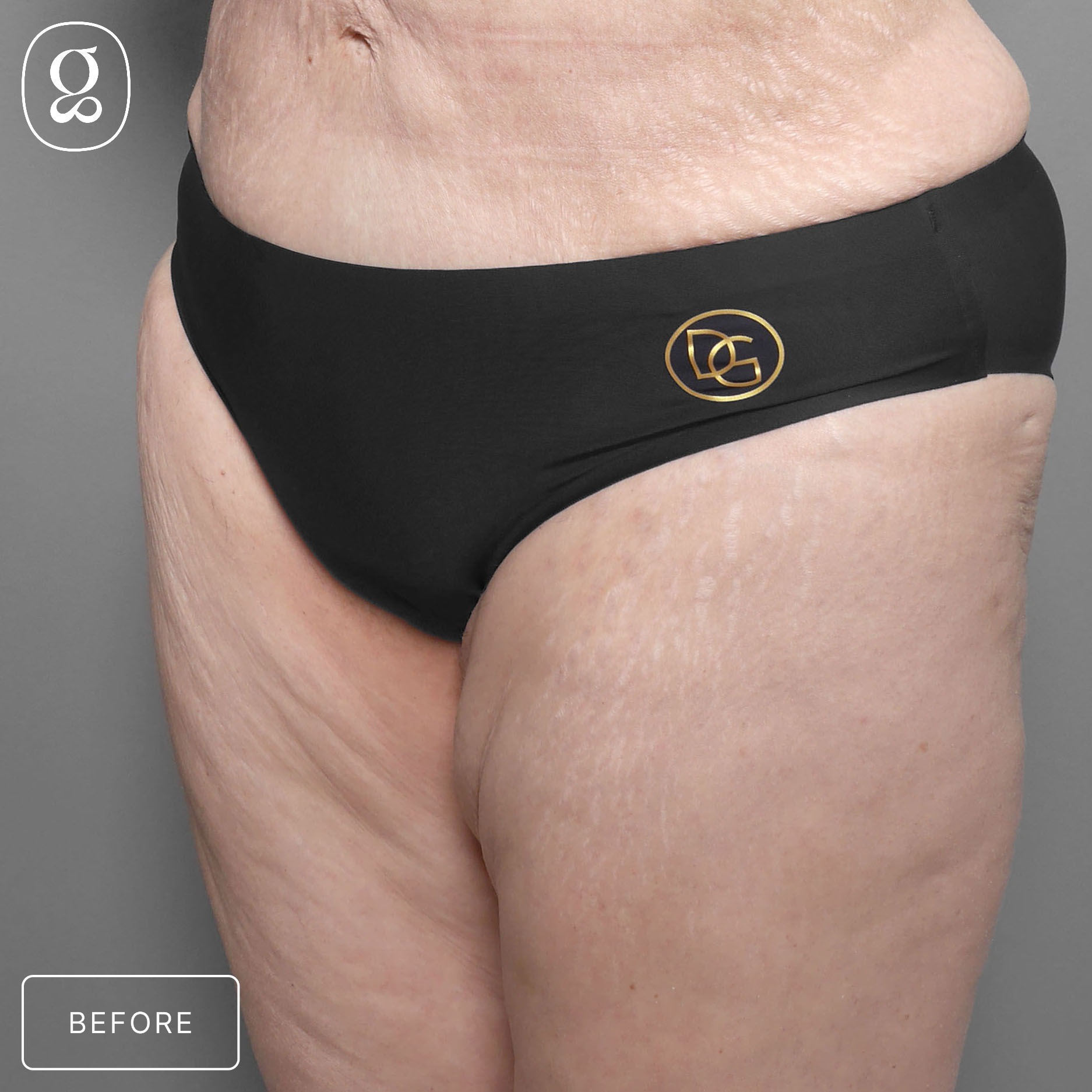 Body Contouring before photo