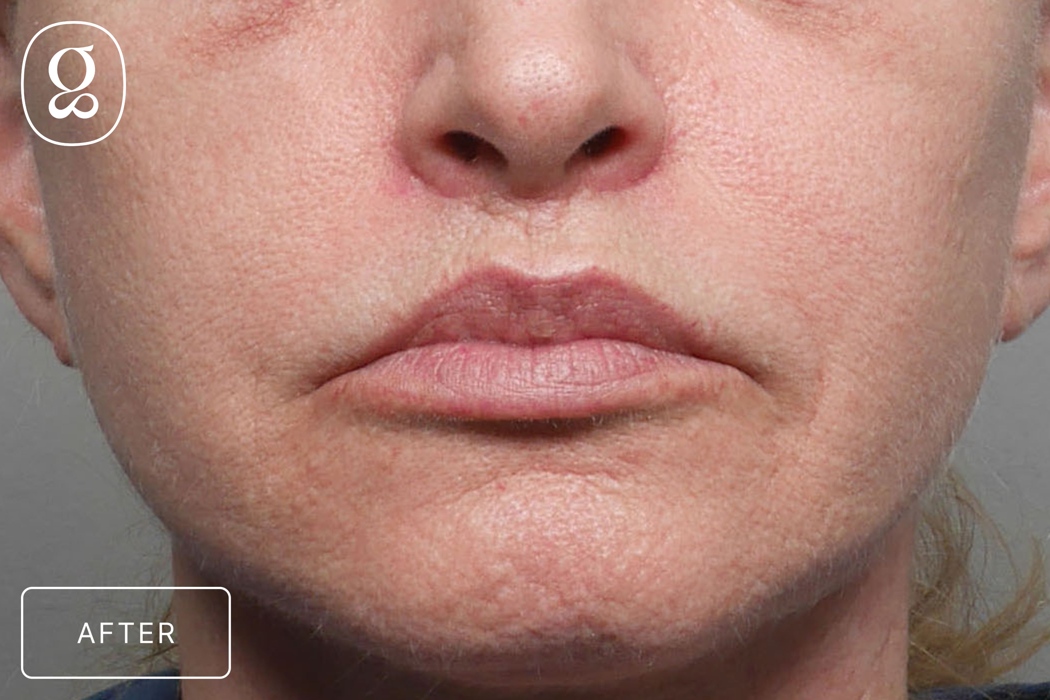 Lip Lift result at Gould Aesthetics