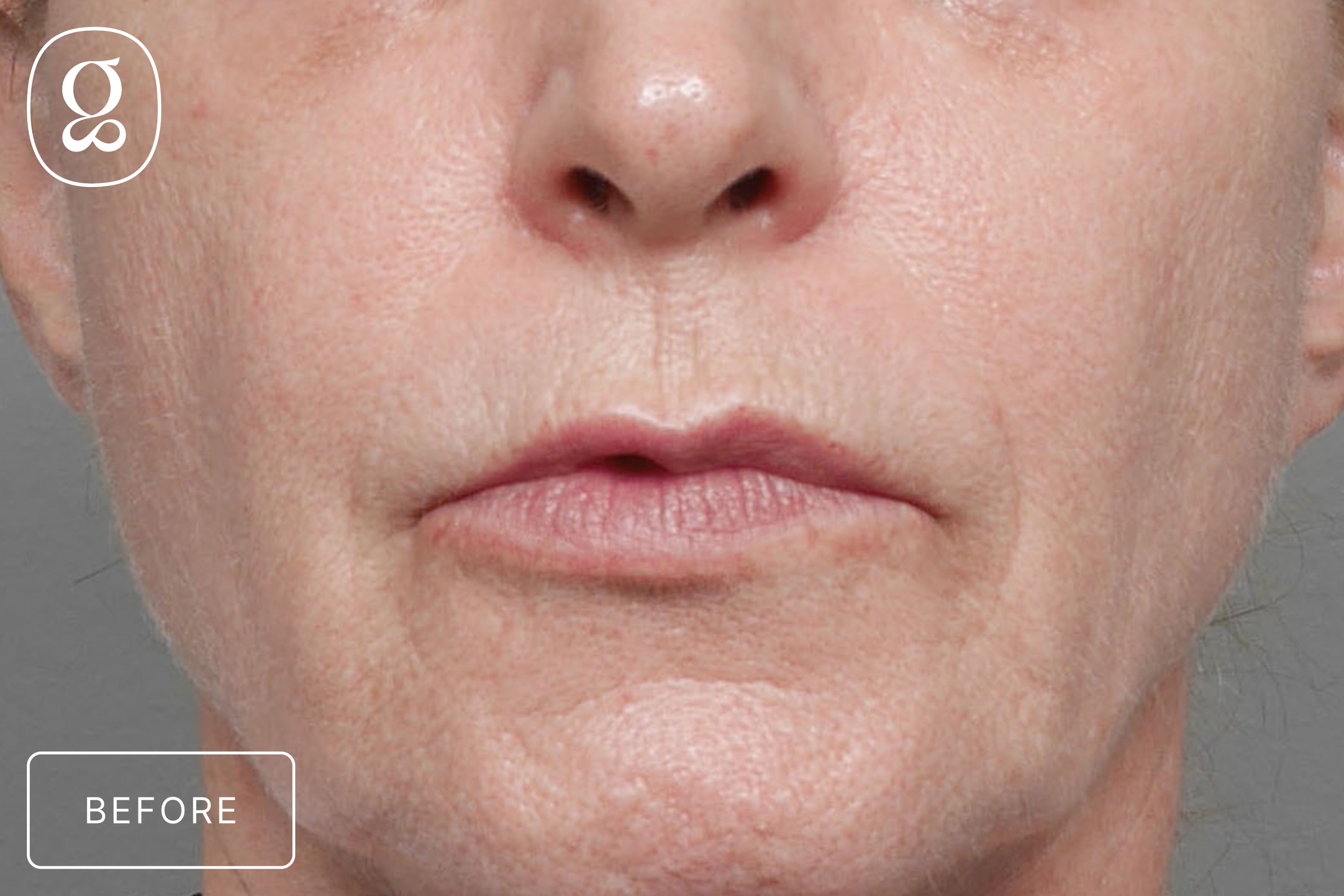 Lip Lift before photo
