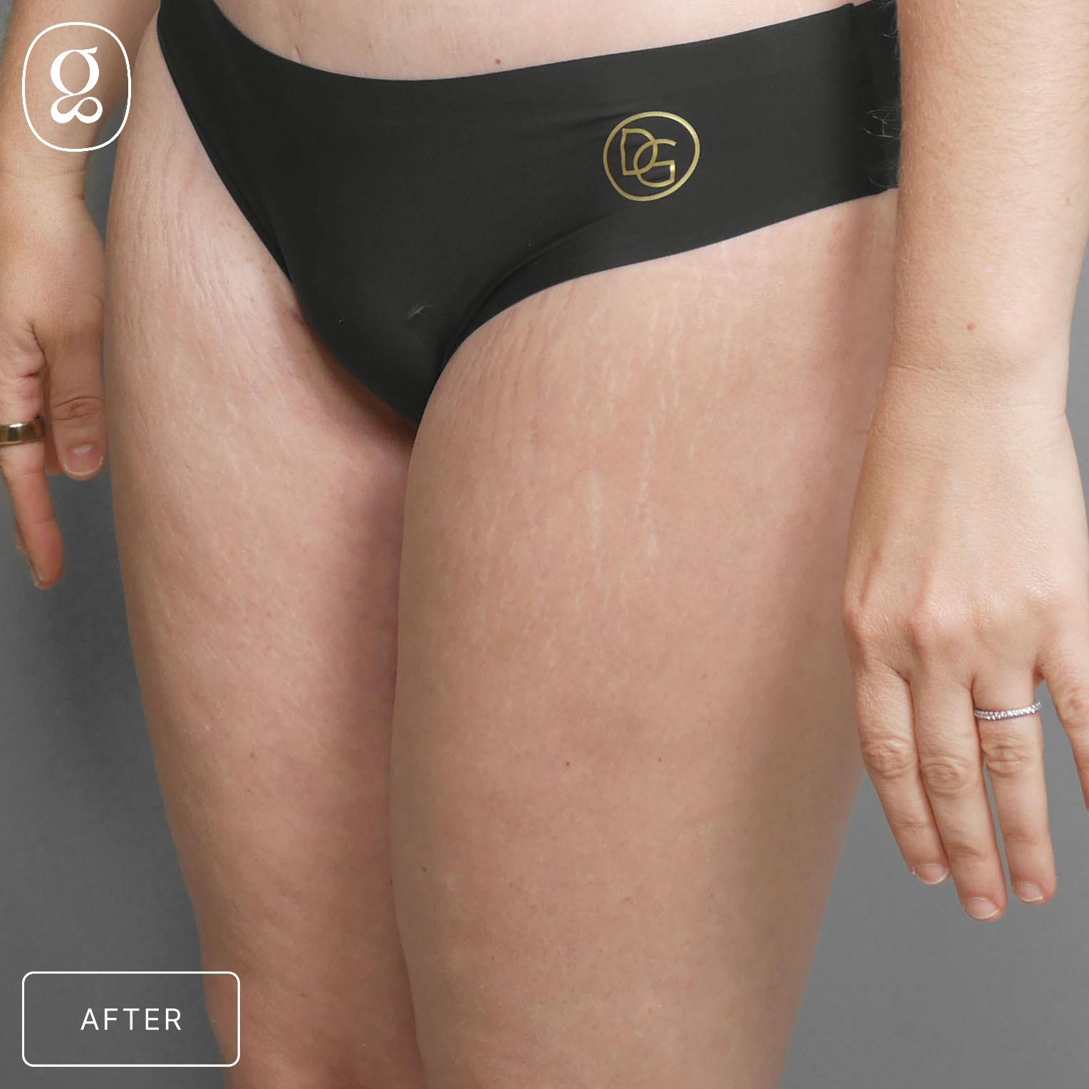 Body Contouring result at Gould Aesthetics