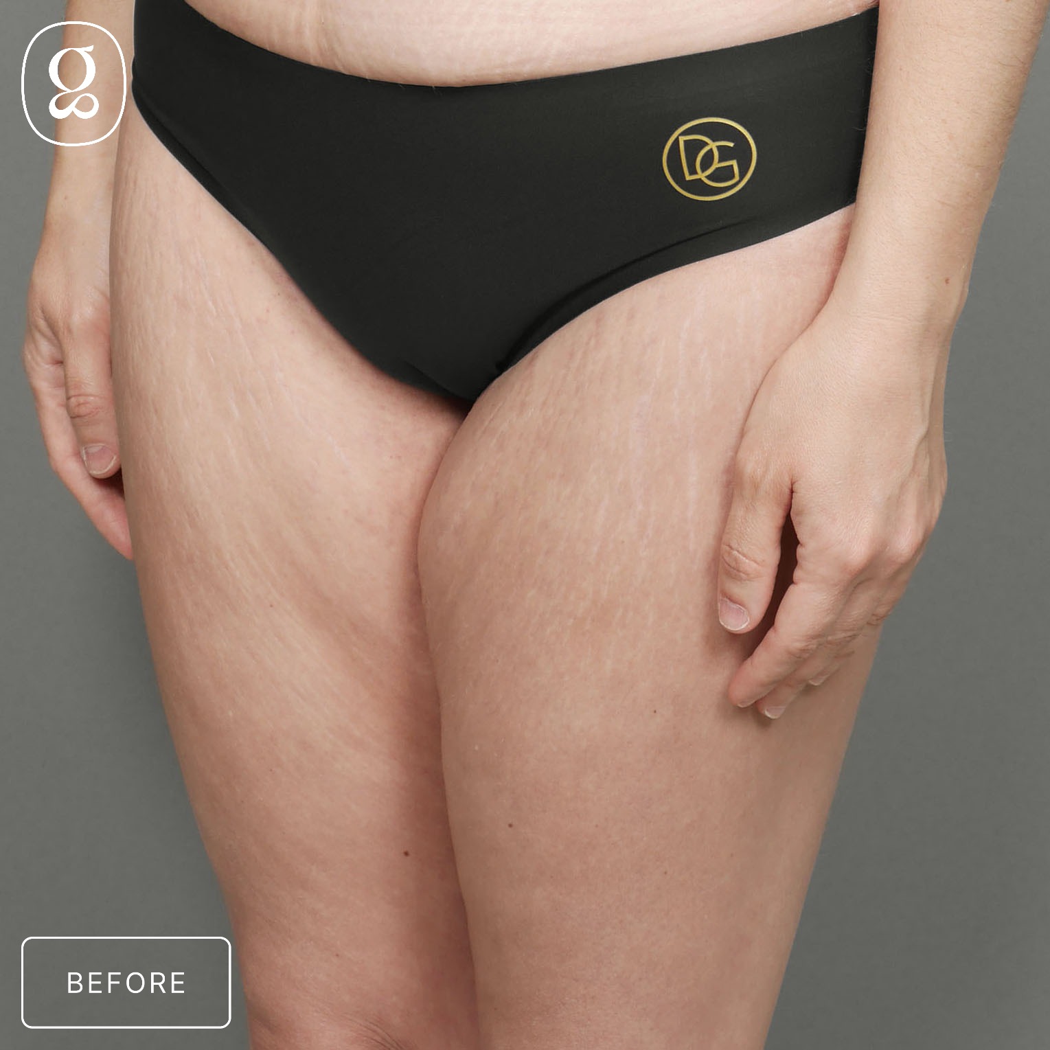 Body Contouring before photo