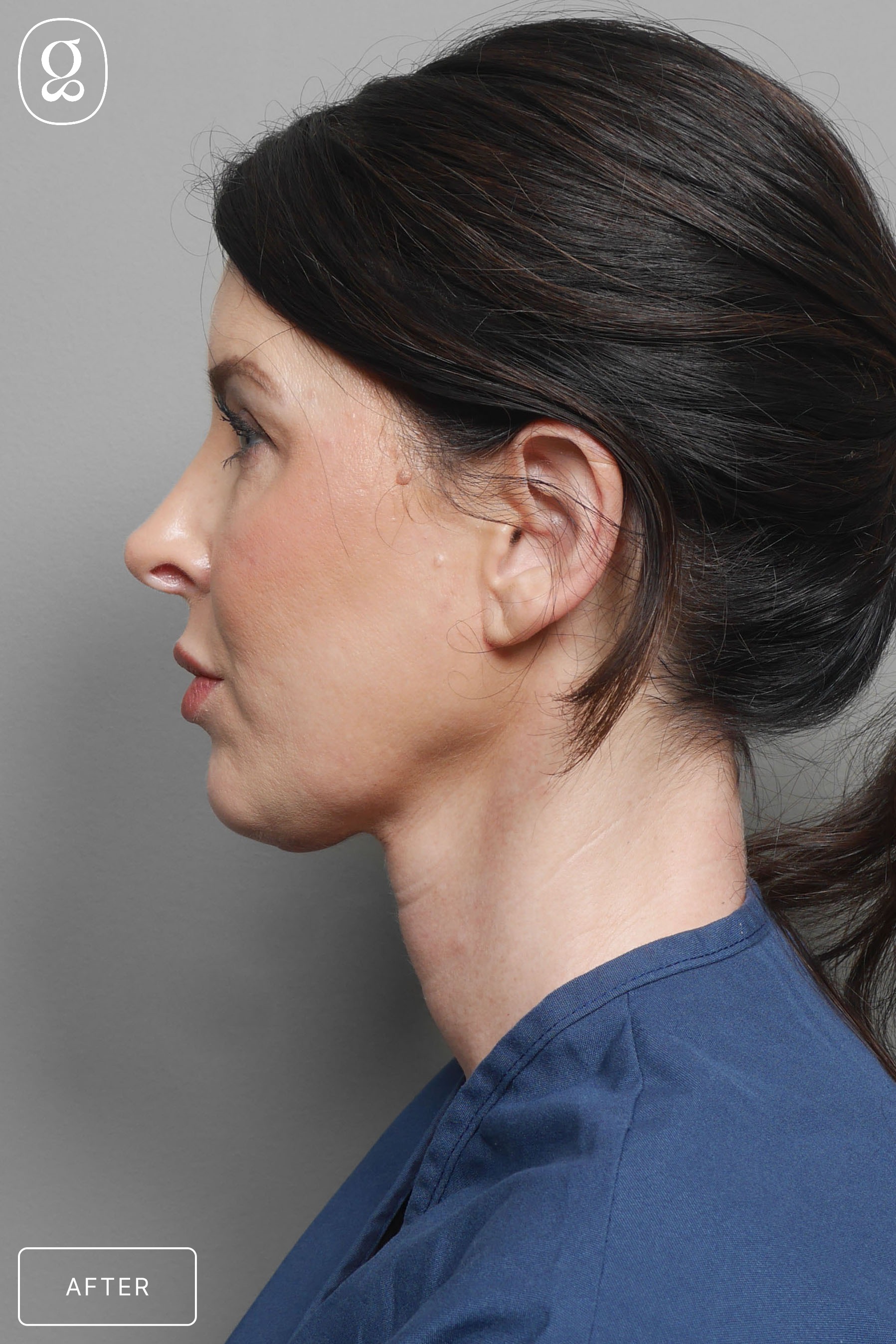 Neck Lift result at Gould Aesthetics