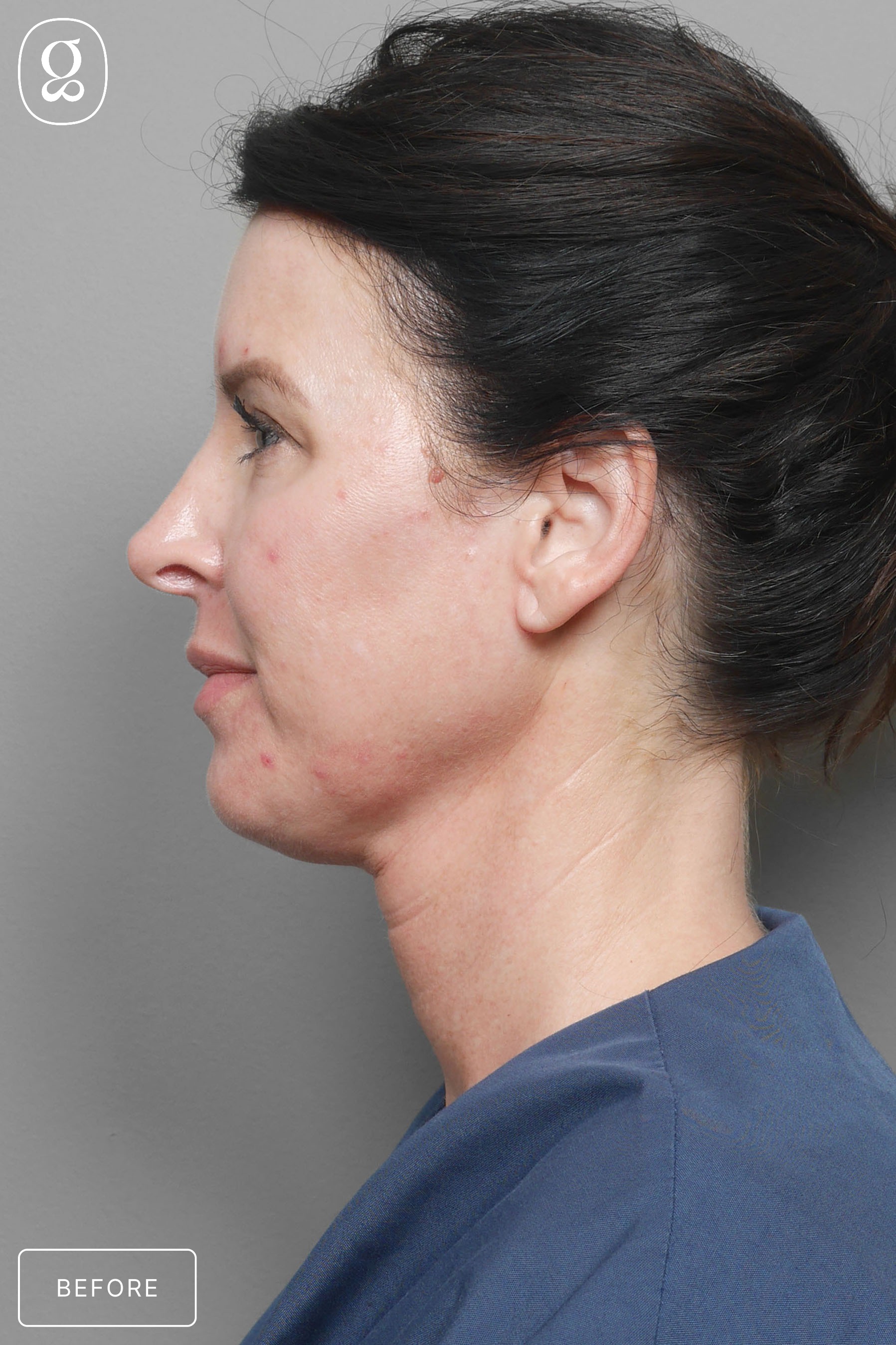 Neck Lift before photo