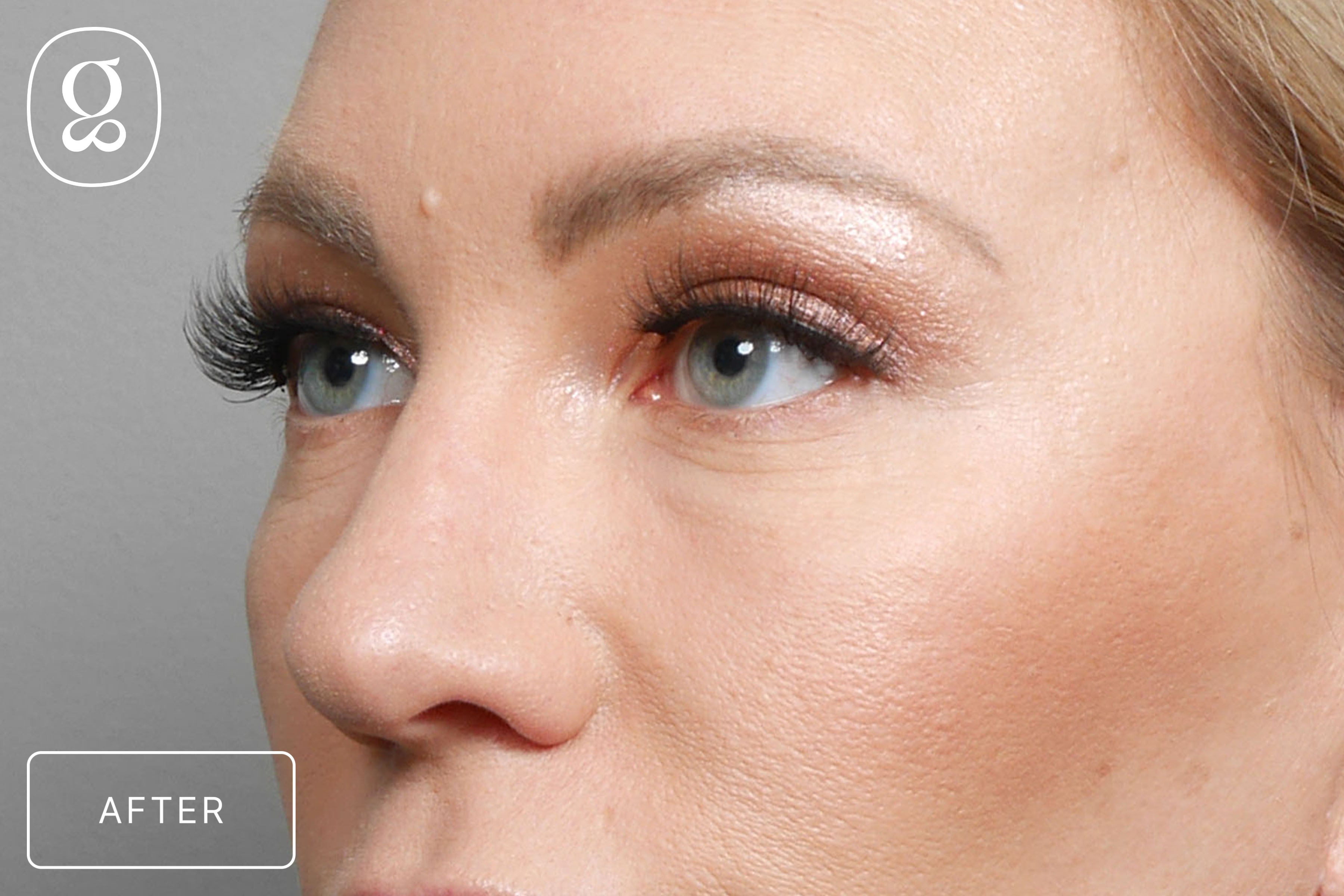 Brow Lift result at Gould Aesthetics