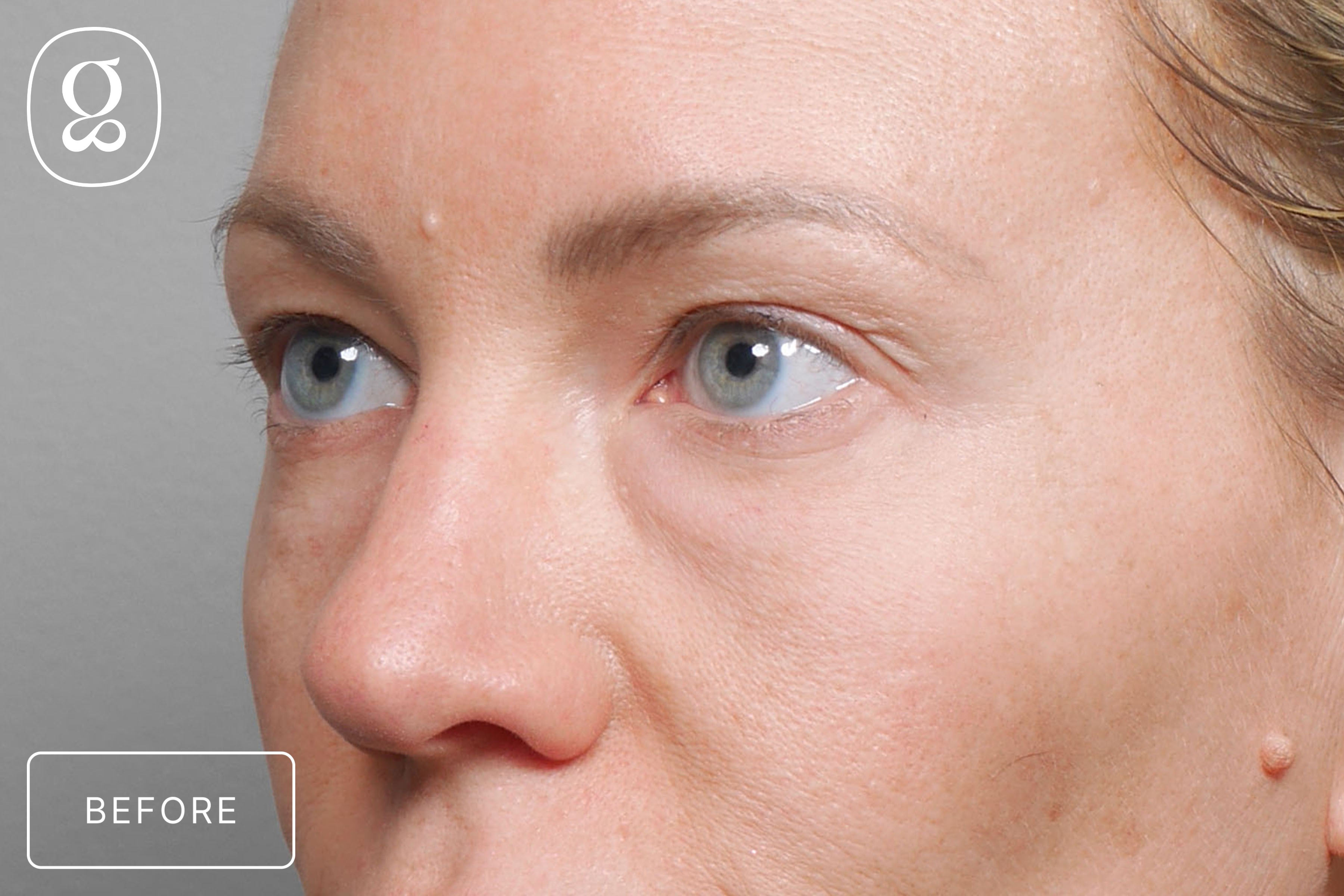 Brow Lift before photo