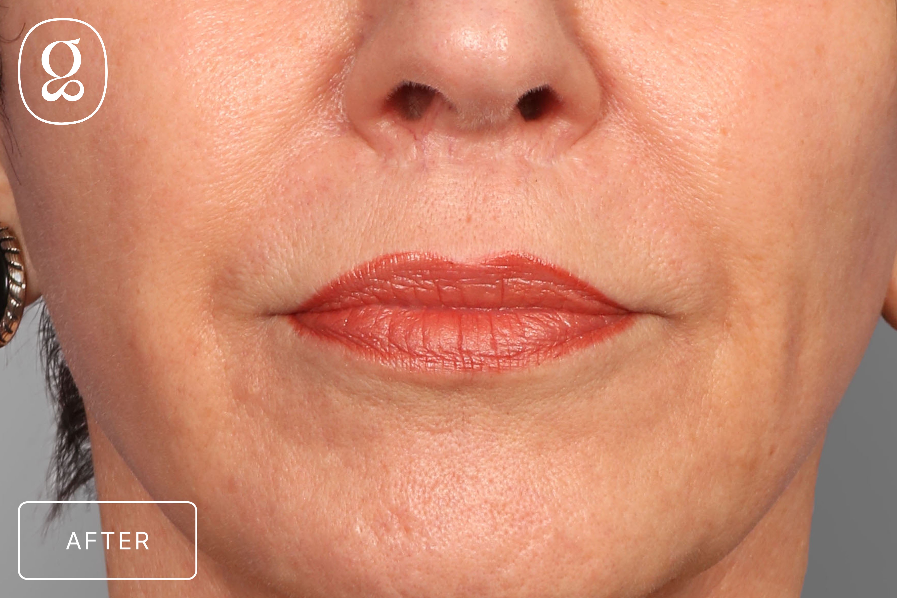 Lip Lift result at Gould Aesthetics