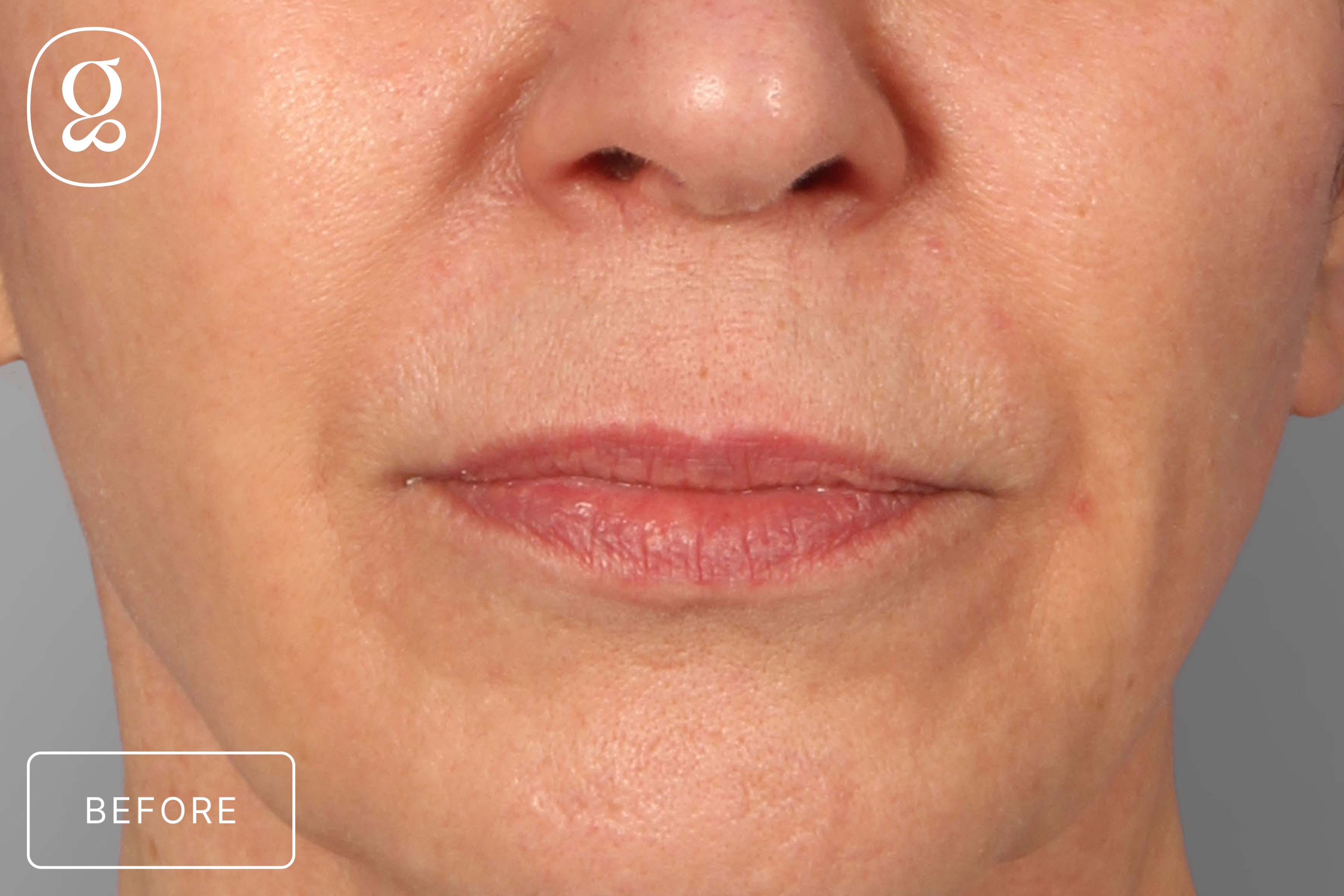 Lip Lift before photo