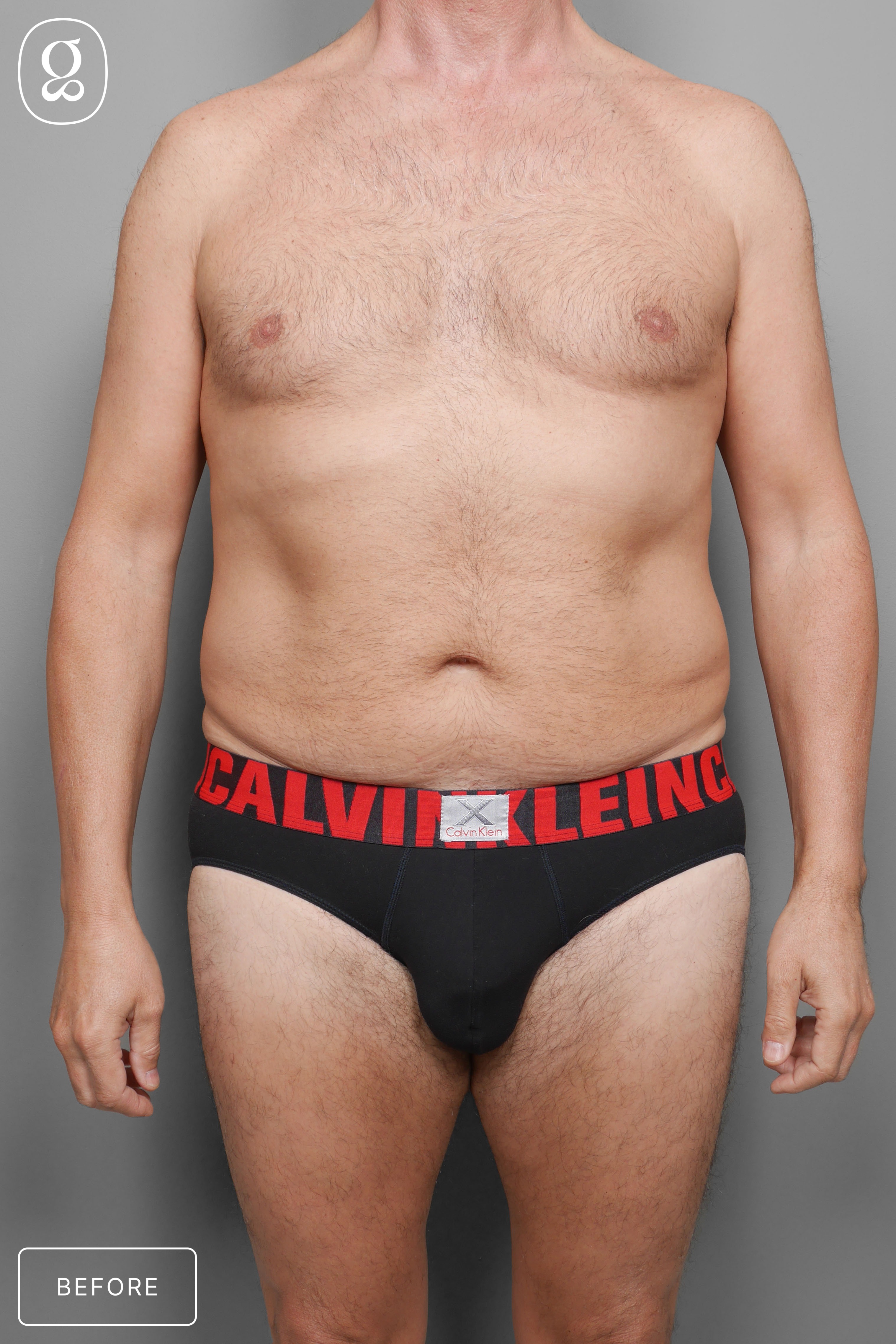 Liposuction before photo