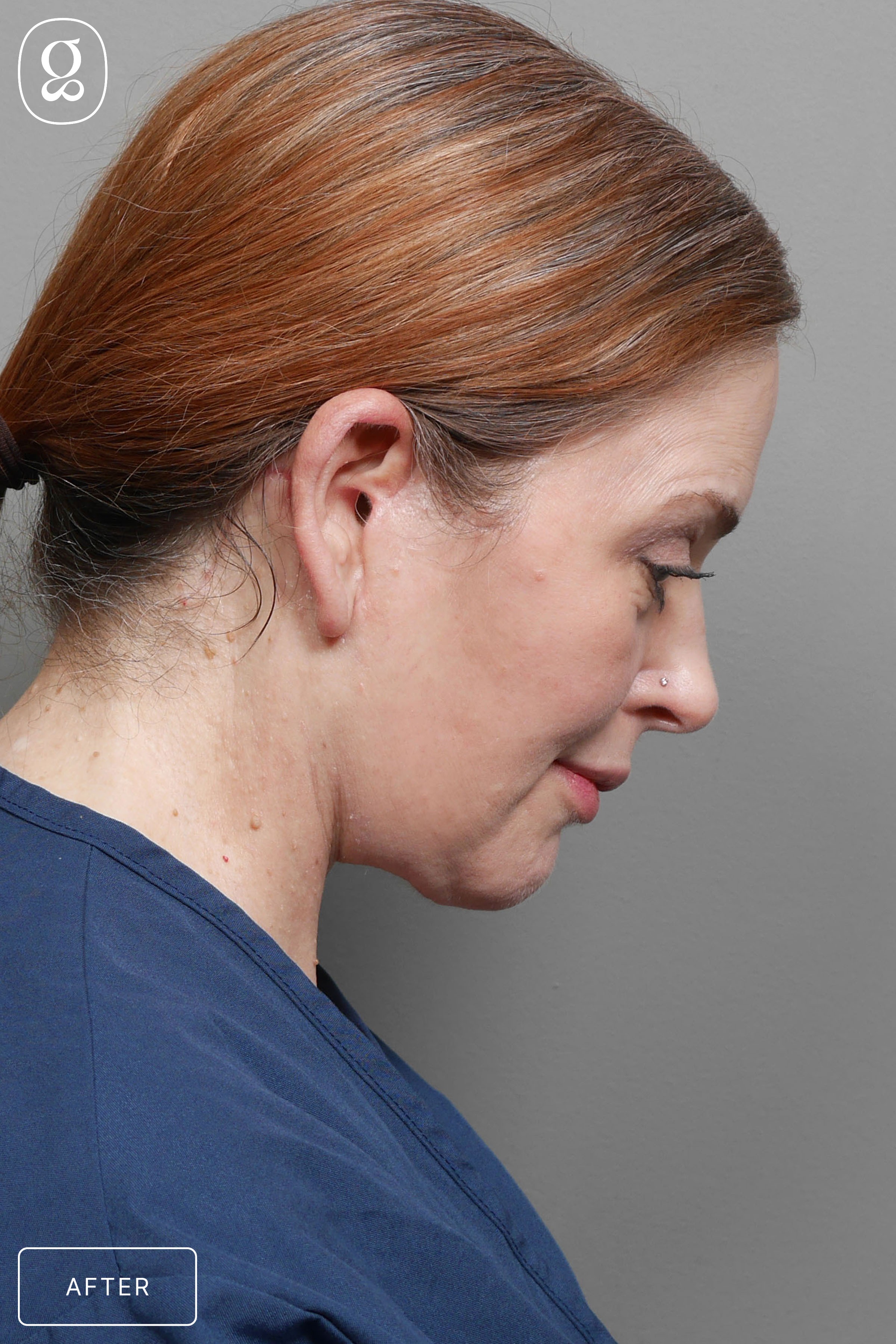 Facelift result at Gould Aesthetics