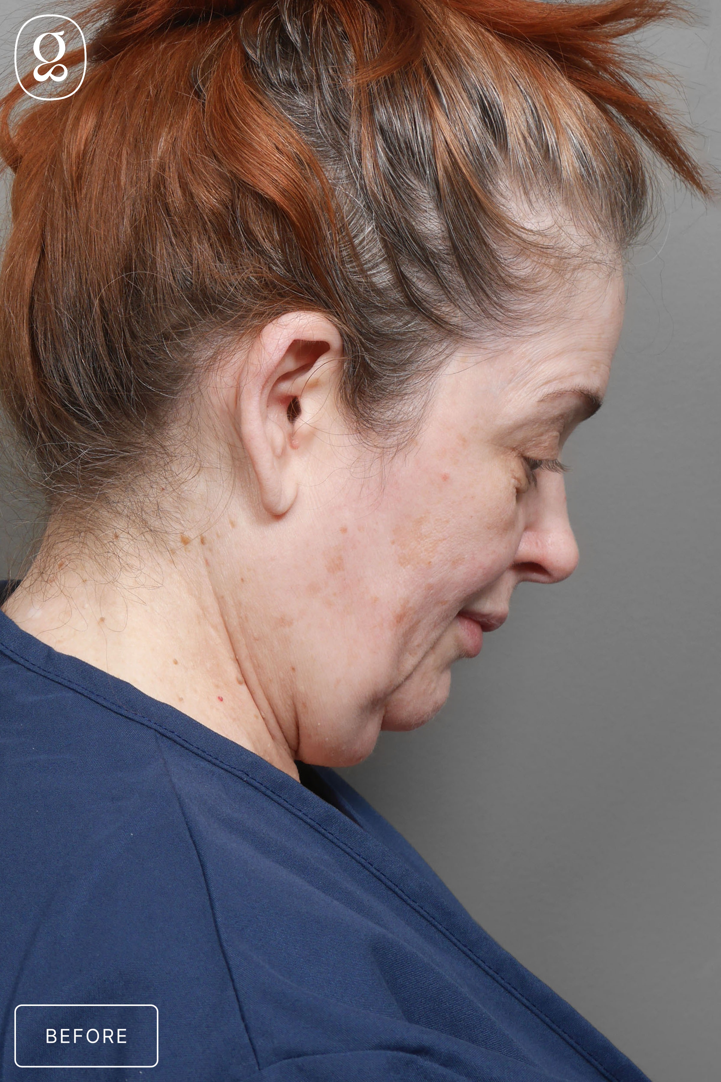 Facelift before photo