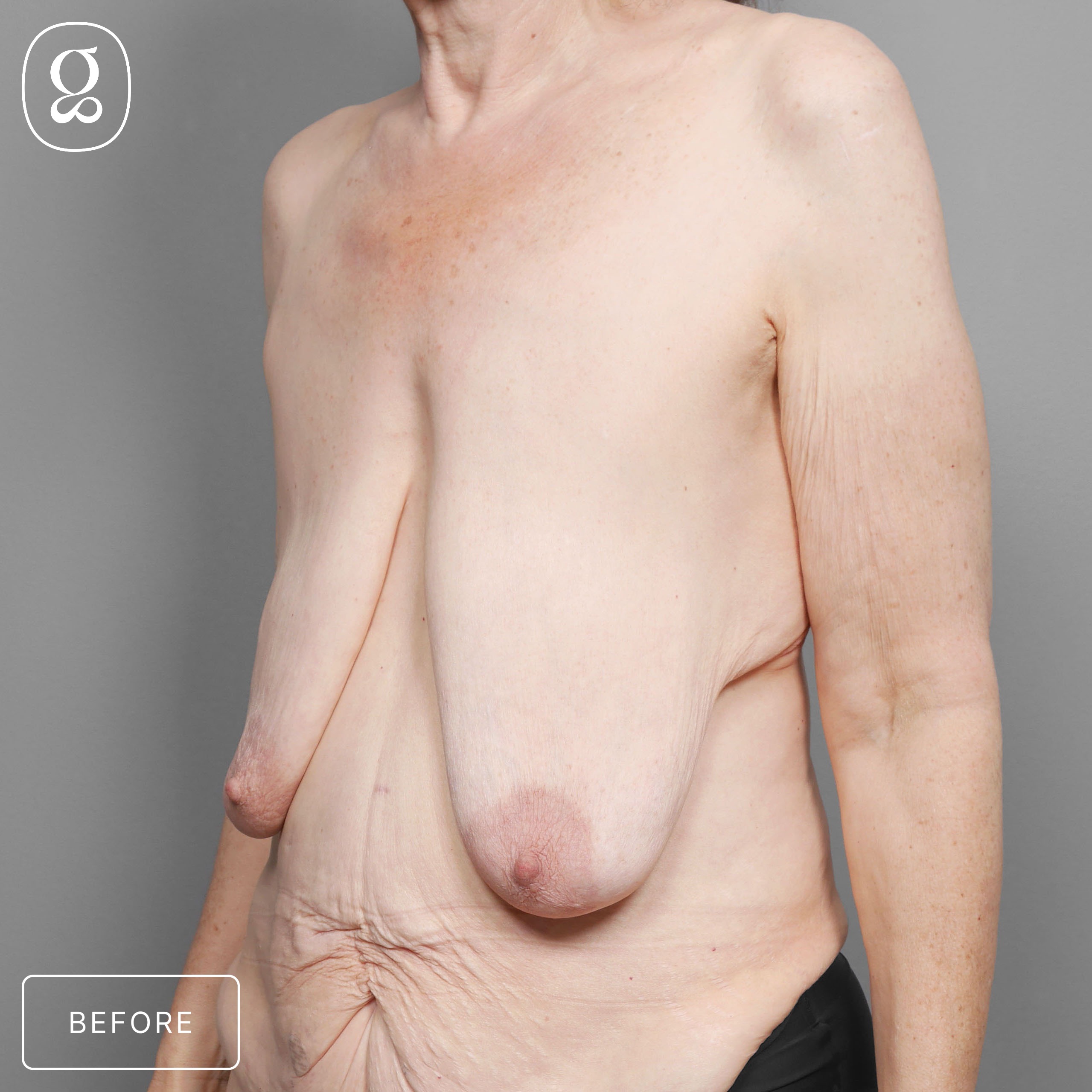 Breast Lift before photo