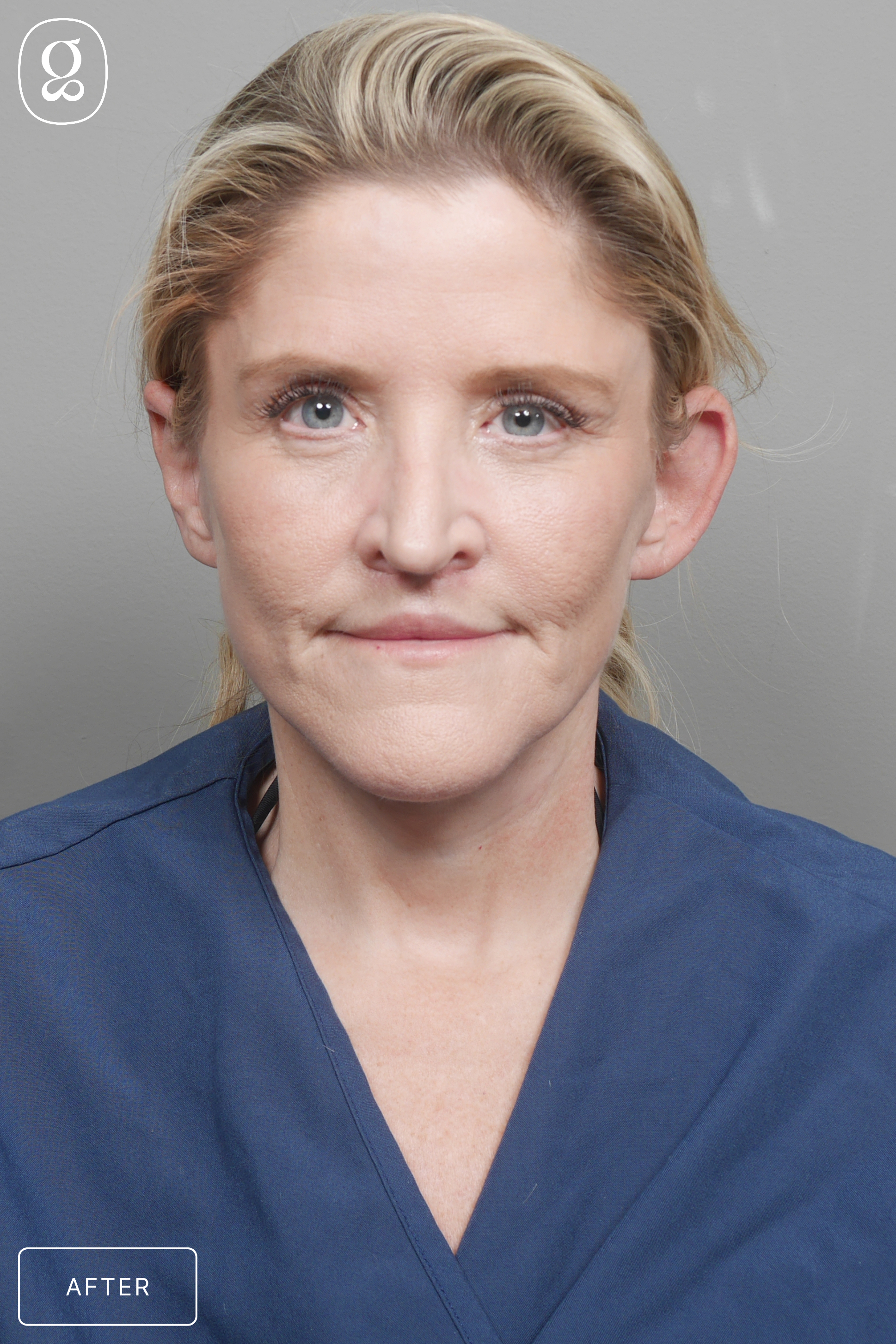 Otoplasty result at Gould Aesthetics