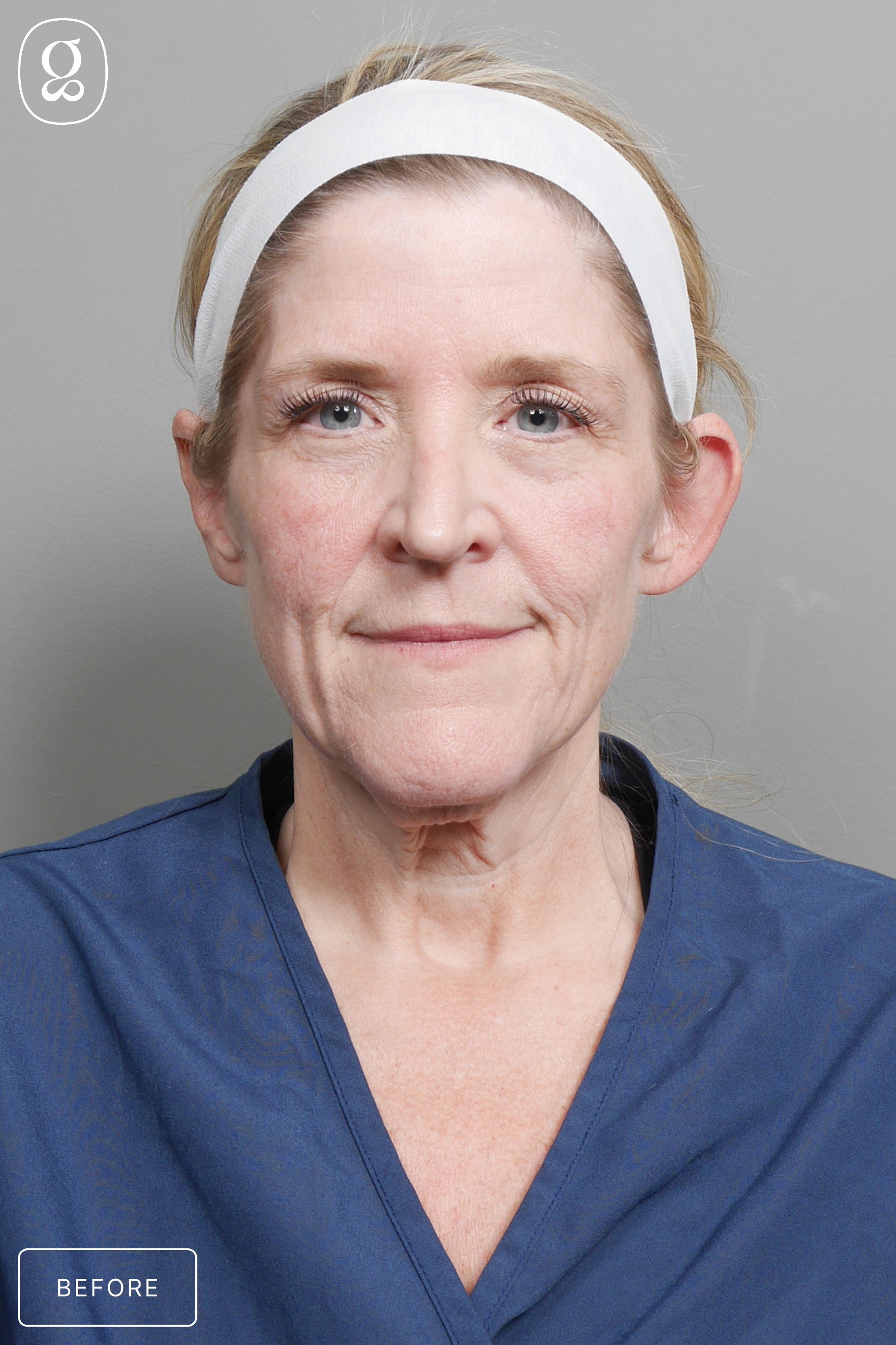 Otoplasty before photo
