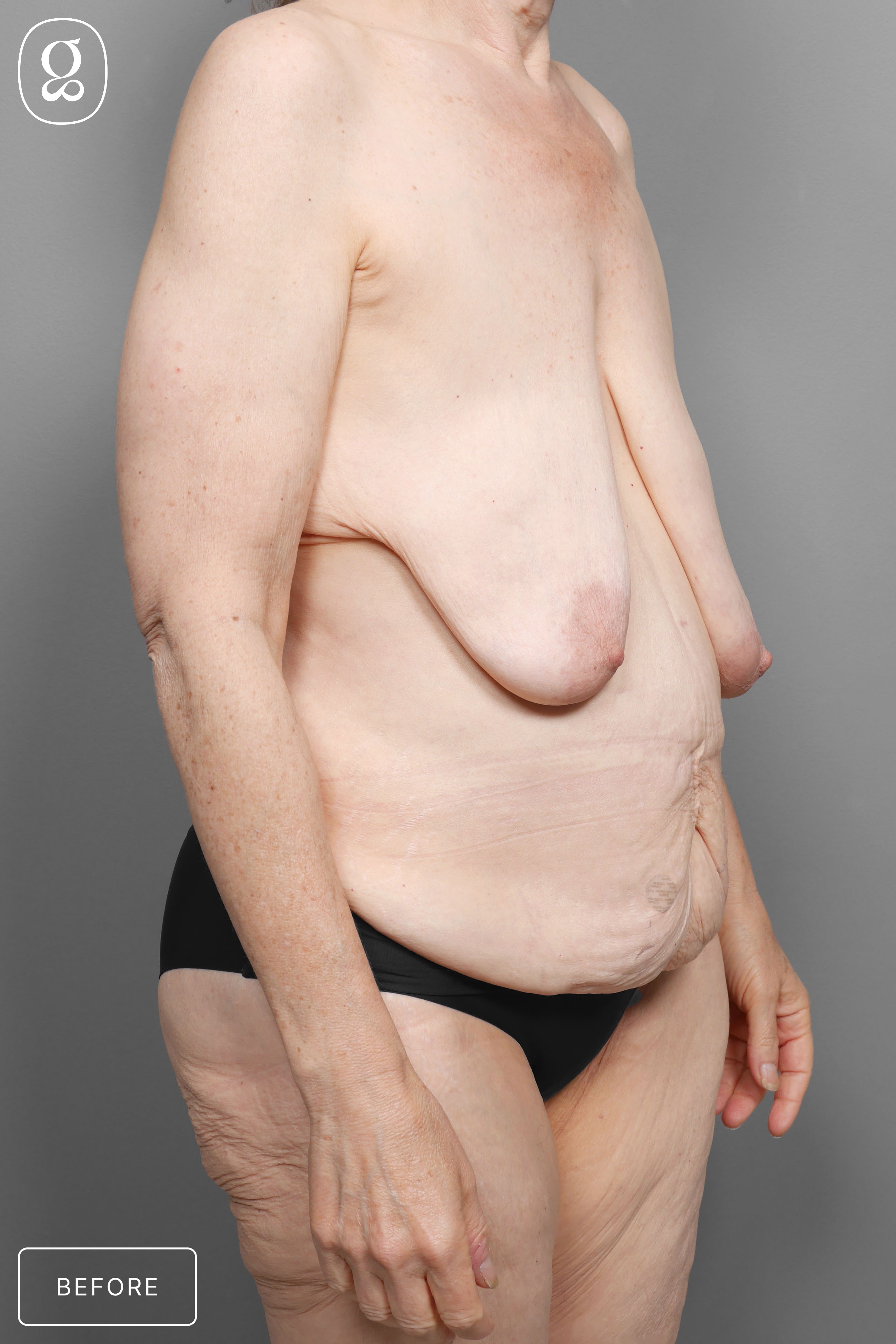 Body Contouring before photo