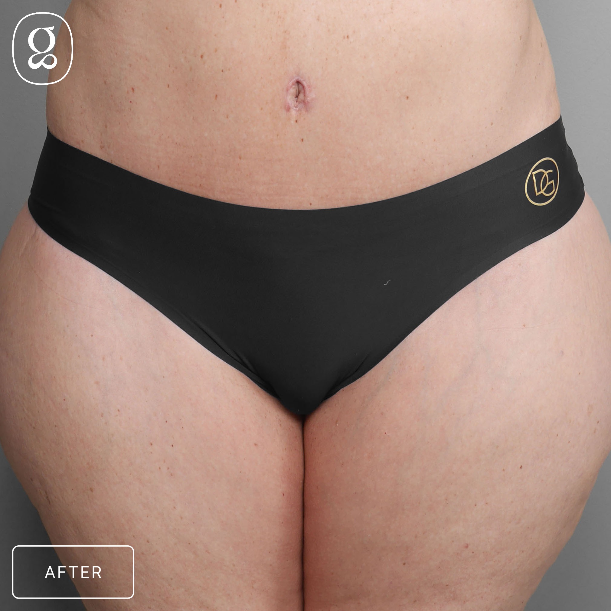 Body Contouring result at Gould Aesthetics