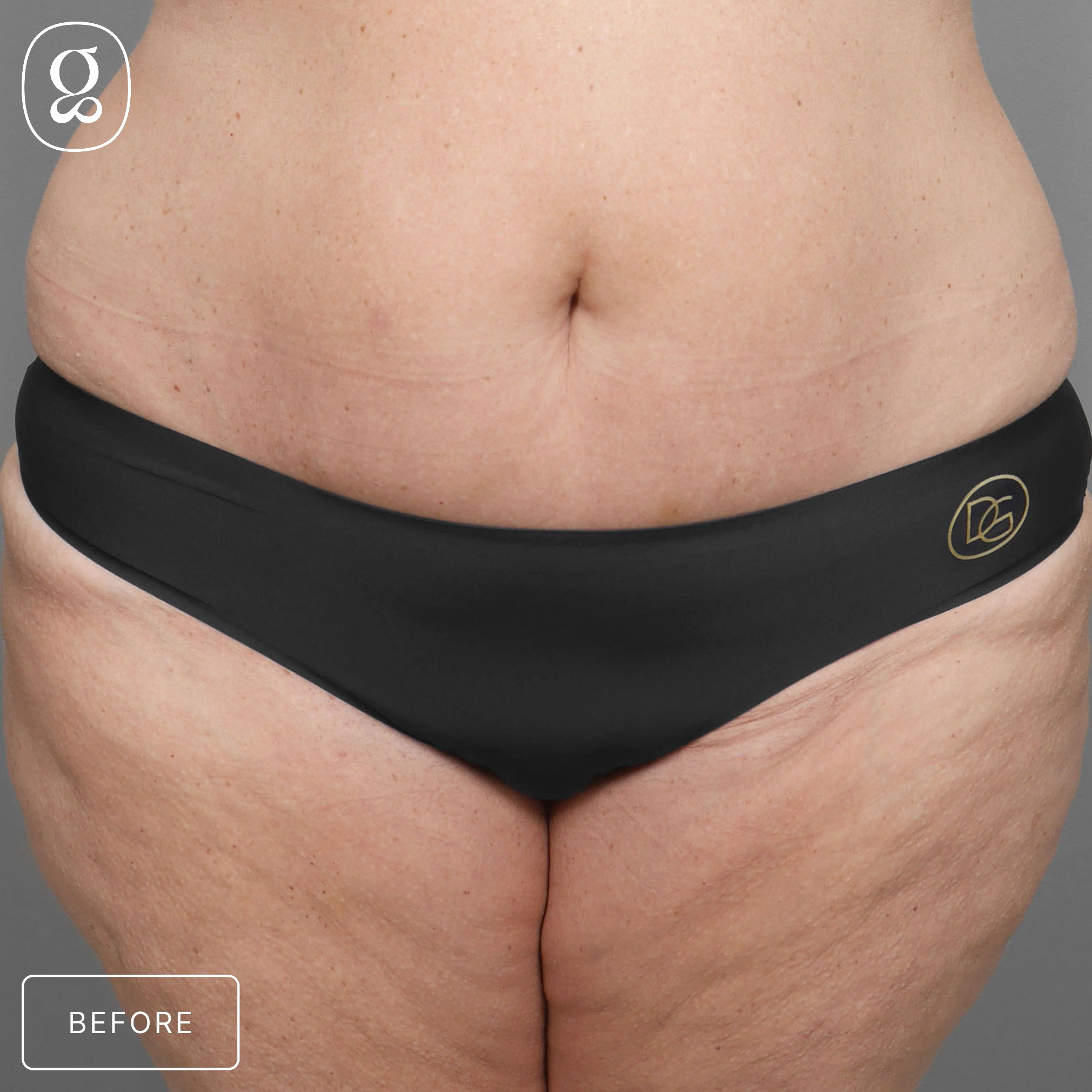 Body Contouring before photo
