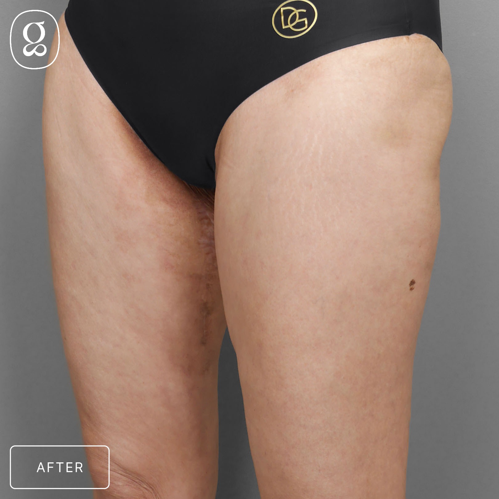 Body Contouring result at Gould Aesthetics
