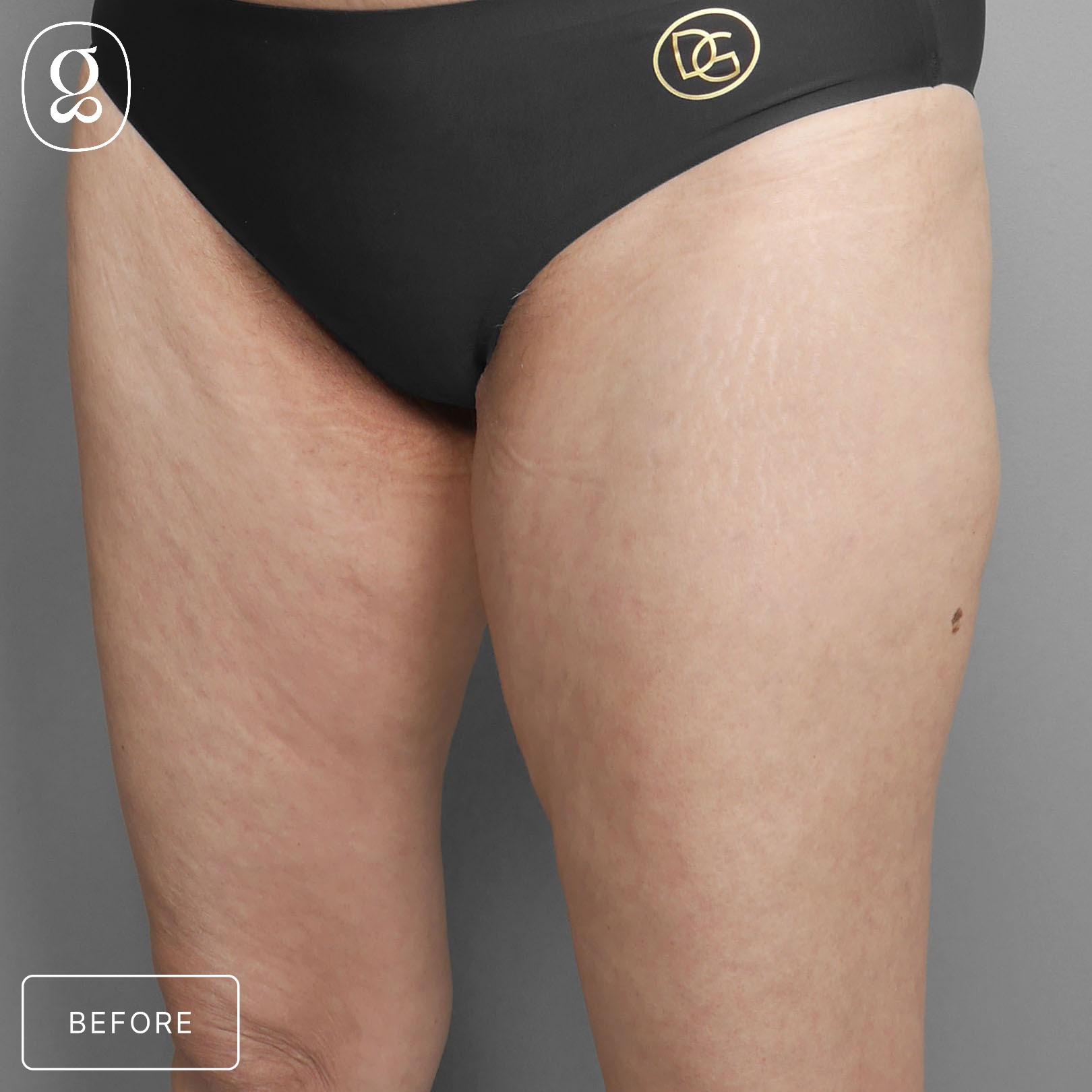 Body Contouring before photo