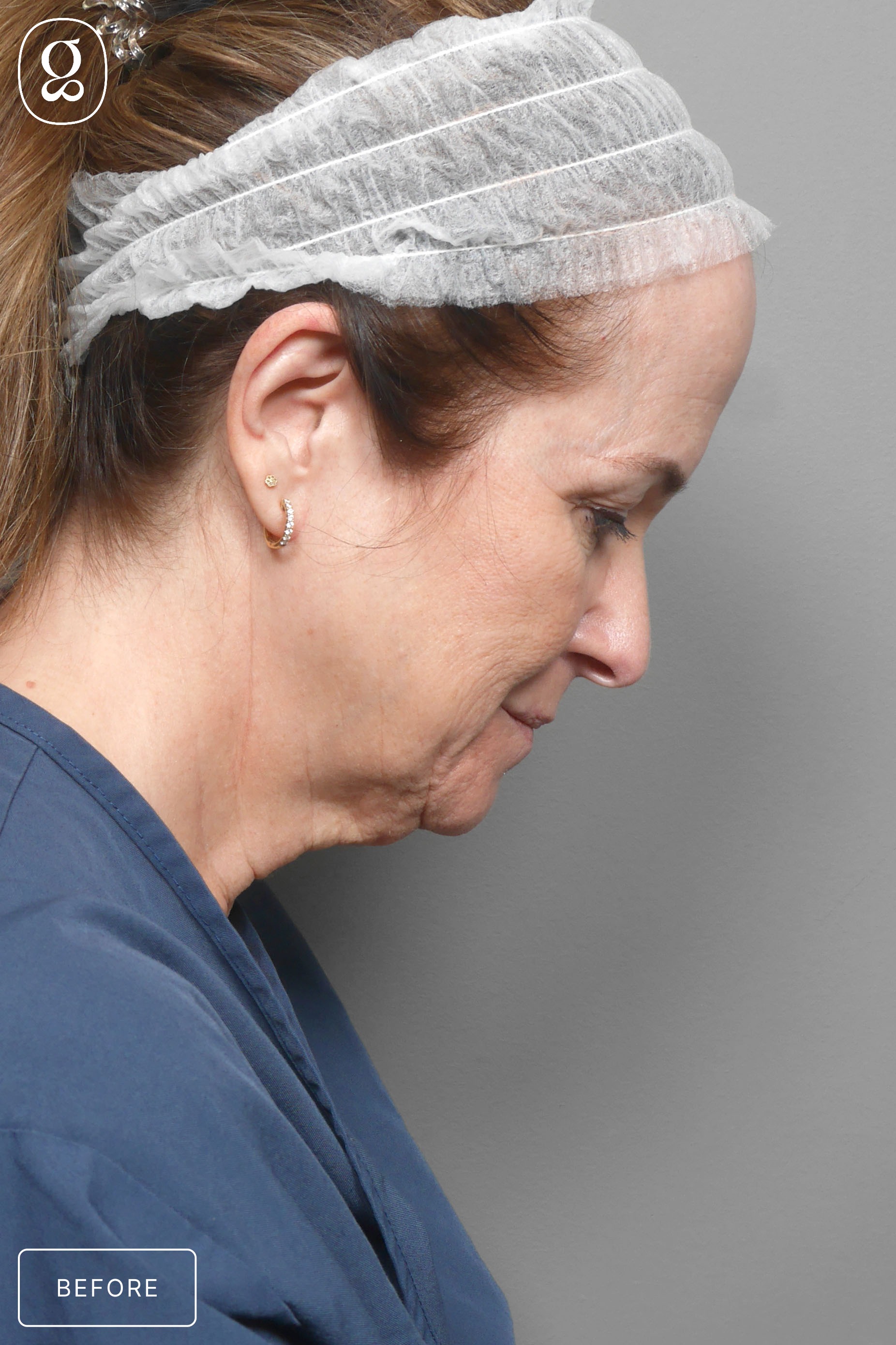 Facelift before photo