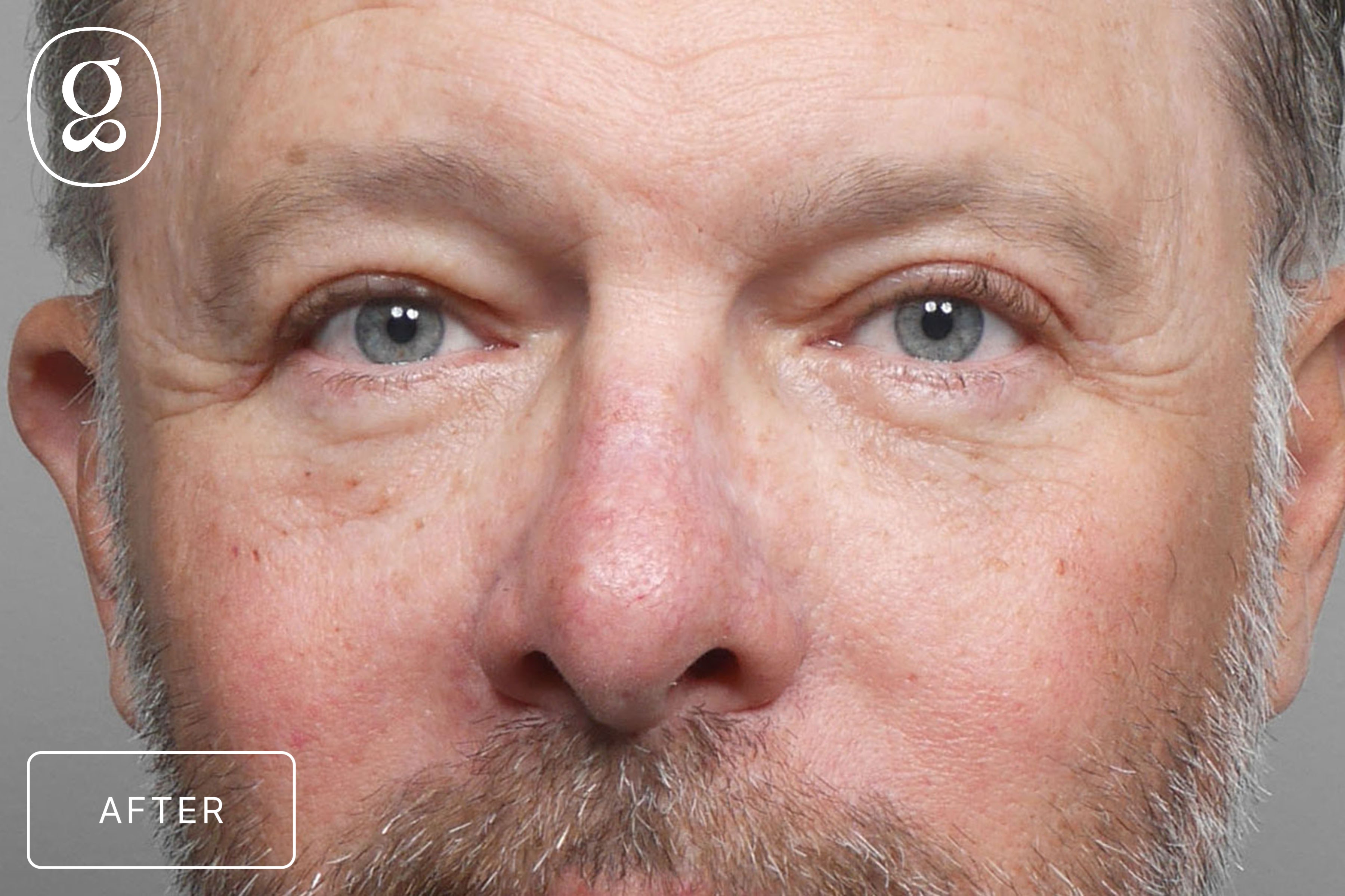 Blepharoplasty result at Gould Aesthetics