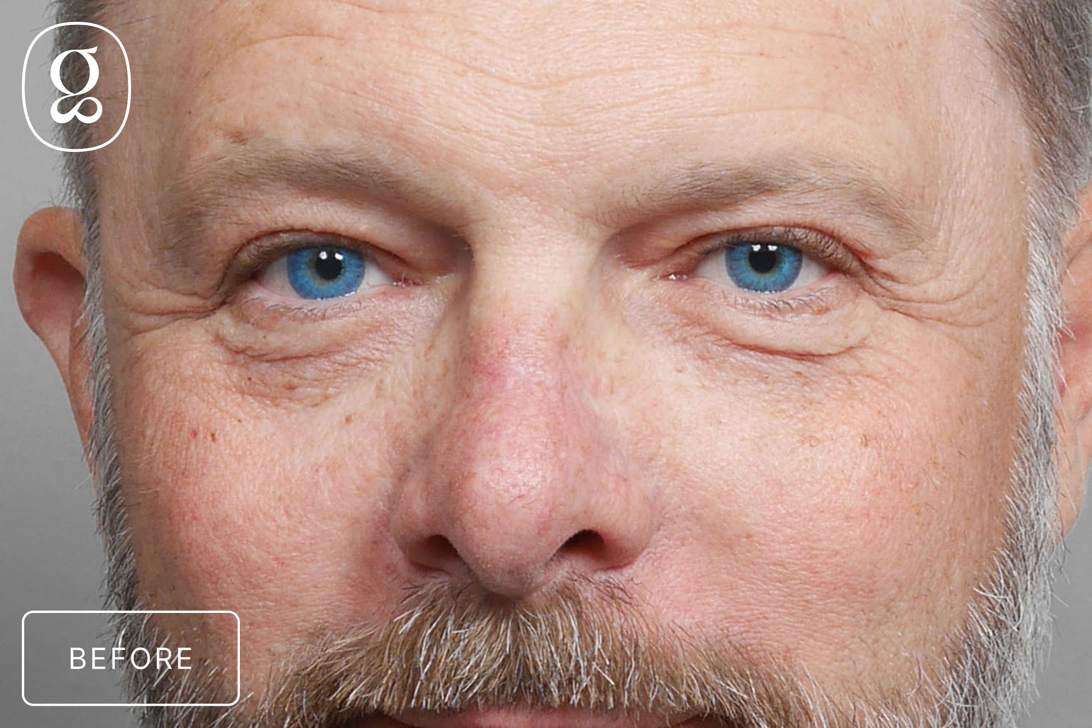 Blepharoplasty before photo