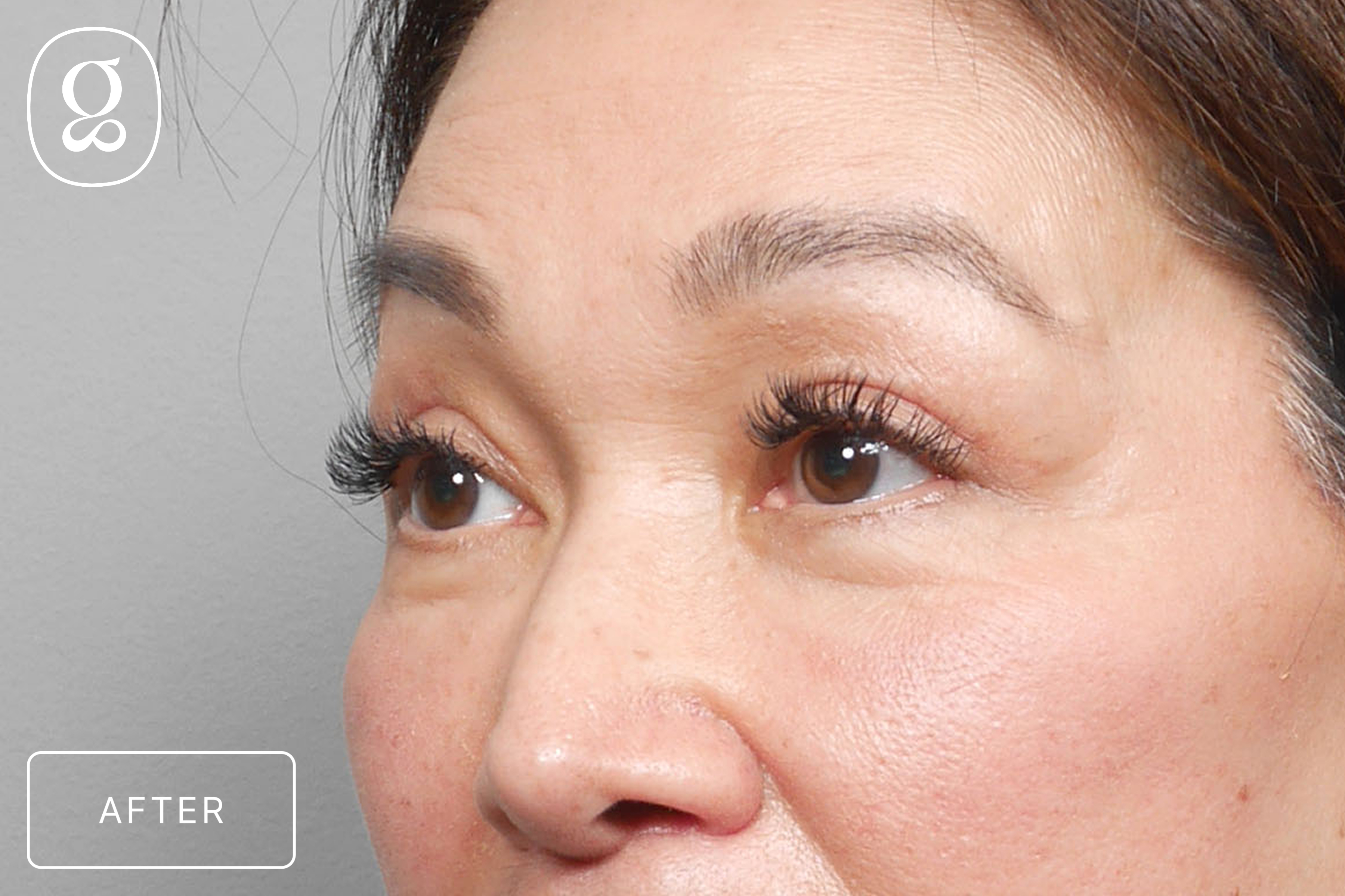 Brow Lift result at Gould Aesthetics
