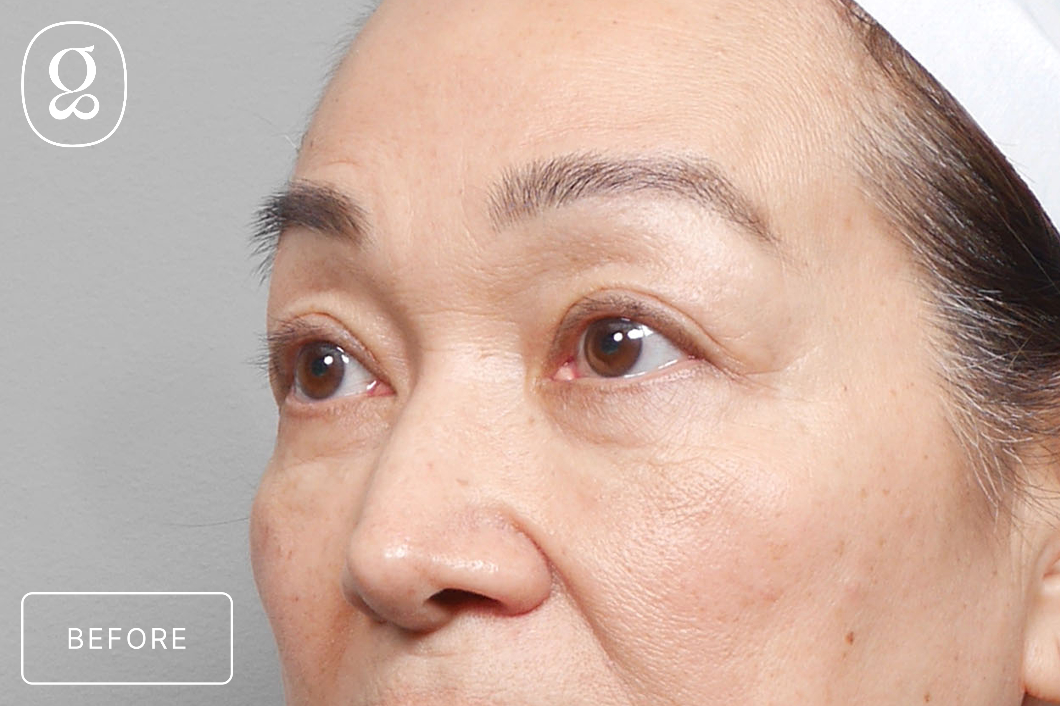 Brow Lift before photo