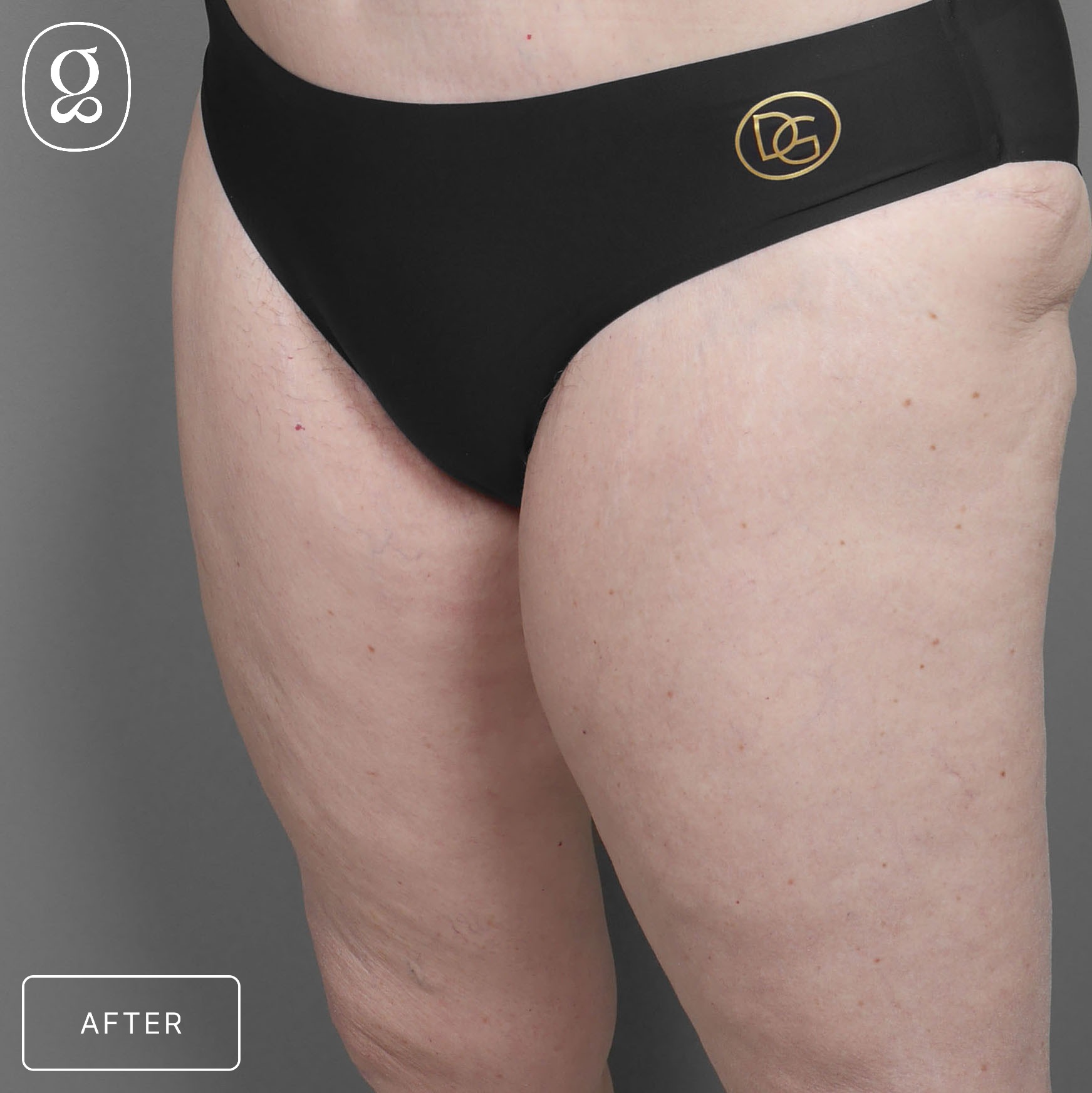 Body Contouring result at Gould Aesthetics