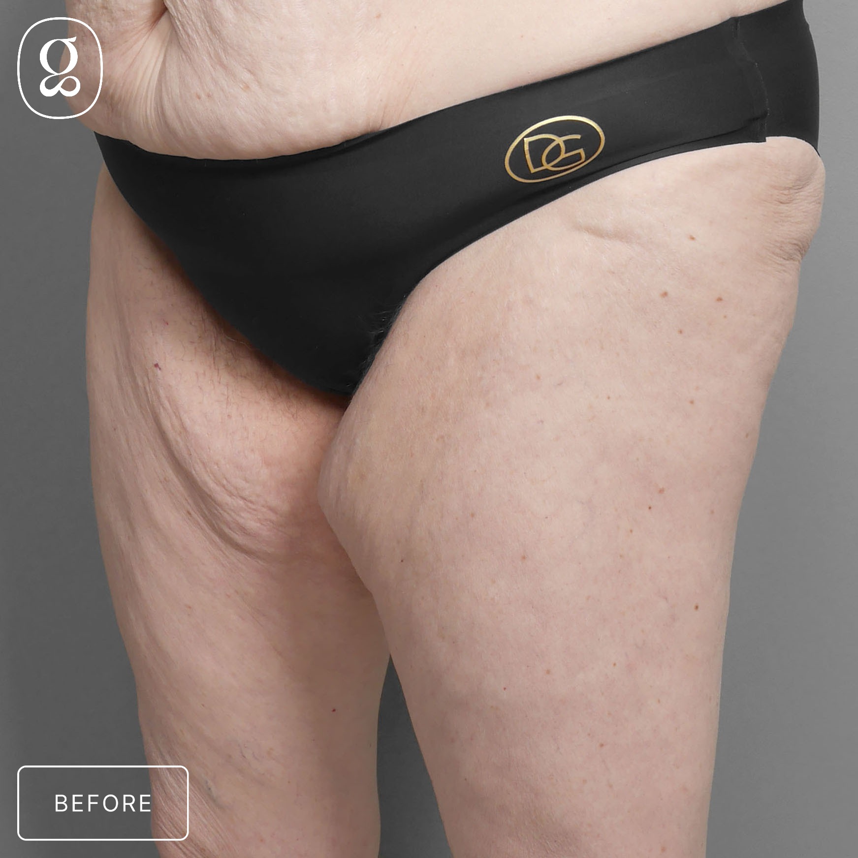 Body Contouring before photo
