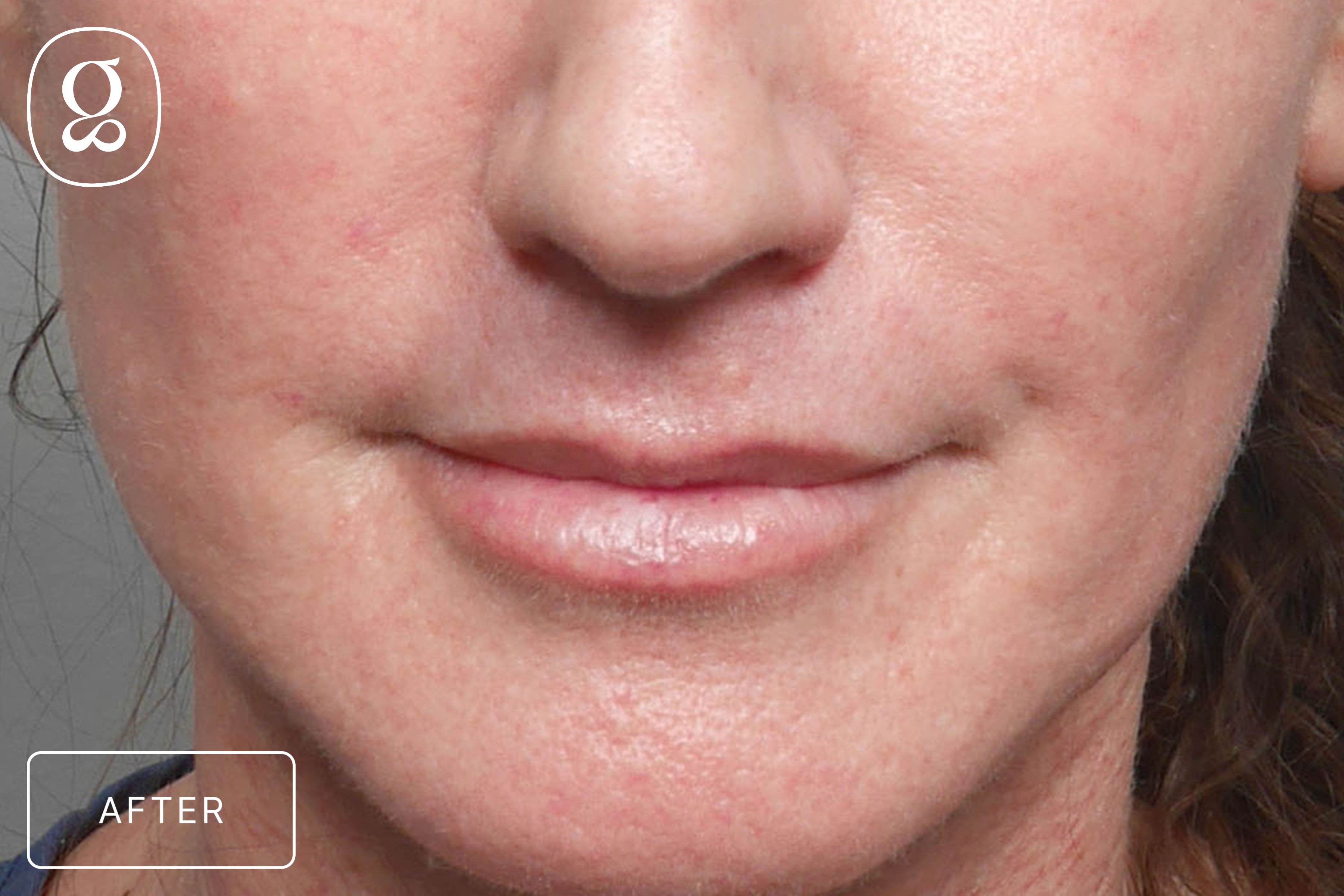 Lip Lift result at Gould Aesthetics