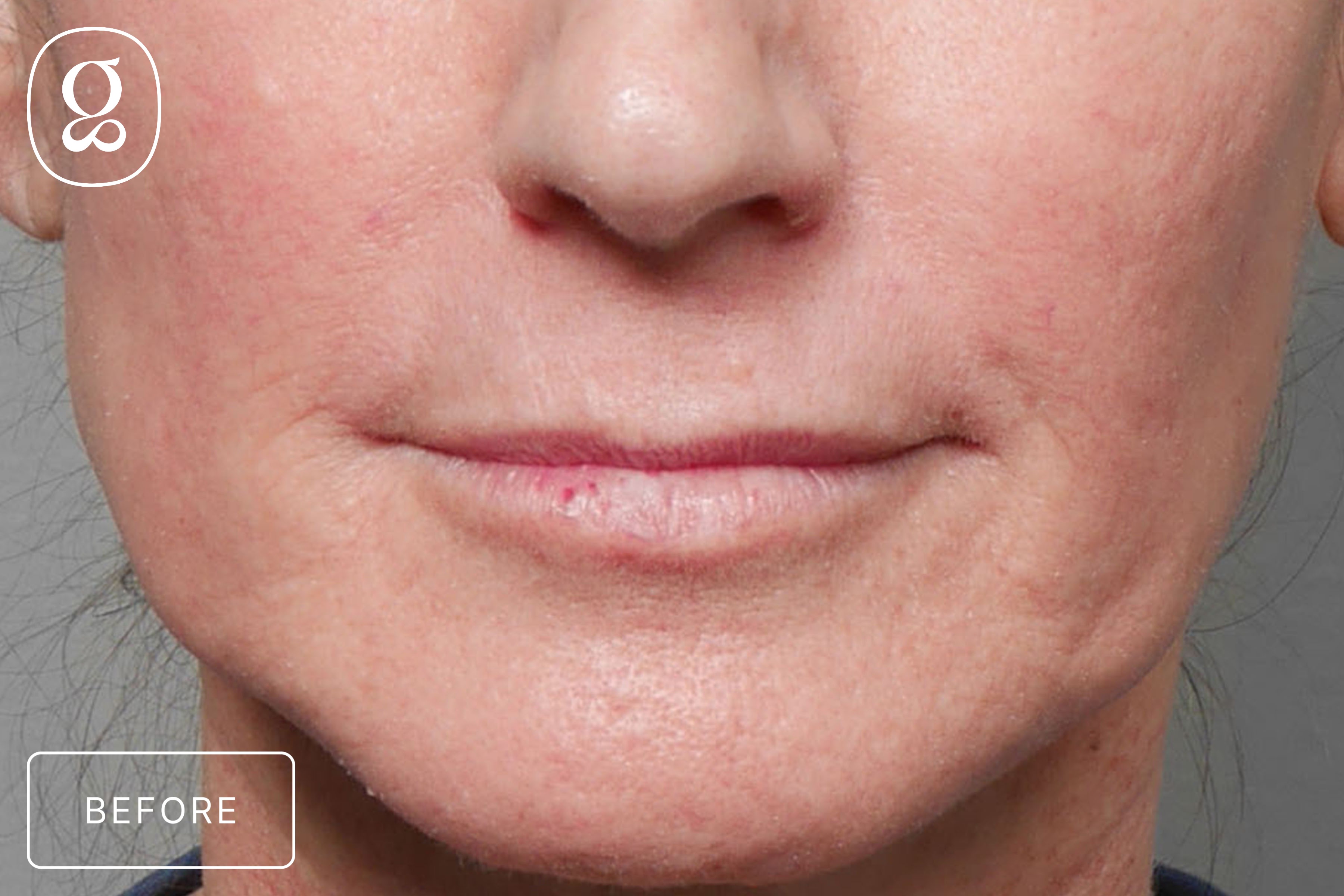 Lip Lift before photo