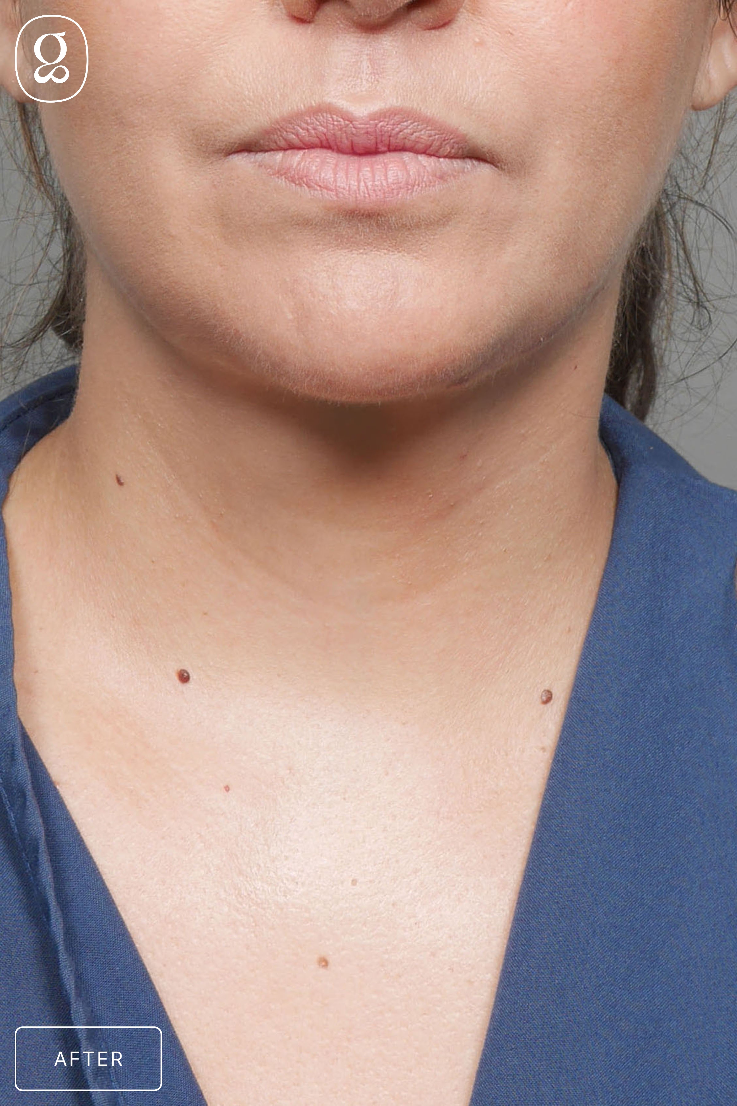 Facelift result at Gould Aesthetics