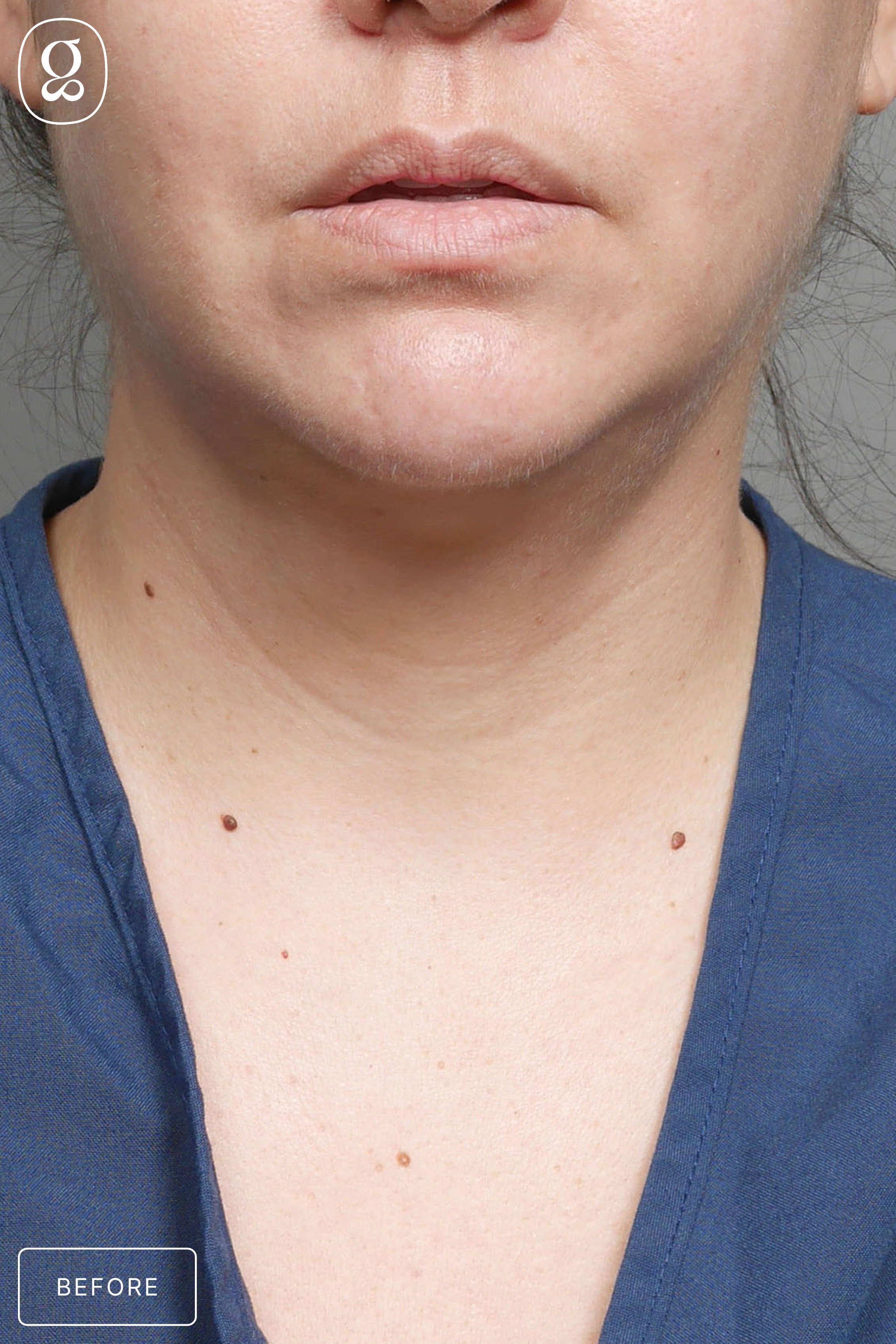 Facelift before photo