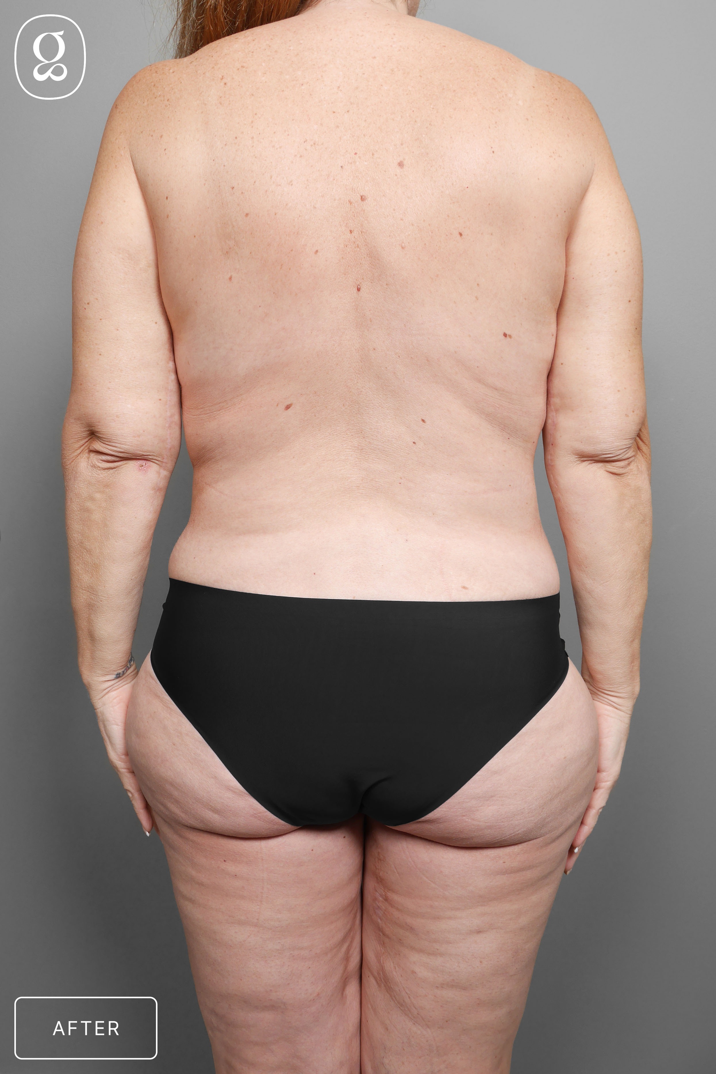 Body Contouring result at Gould Aesthetics
