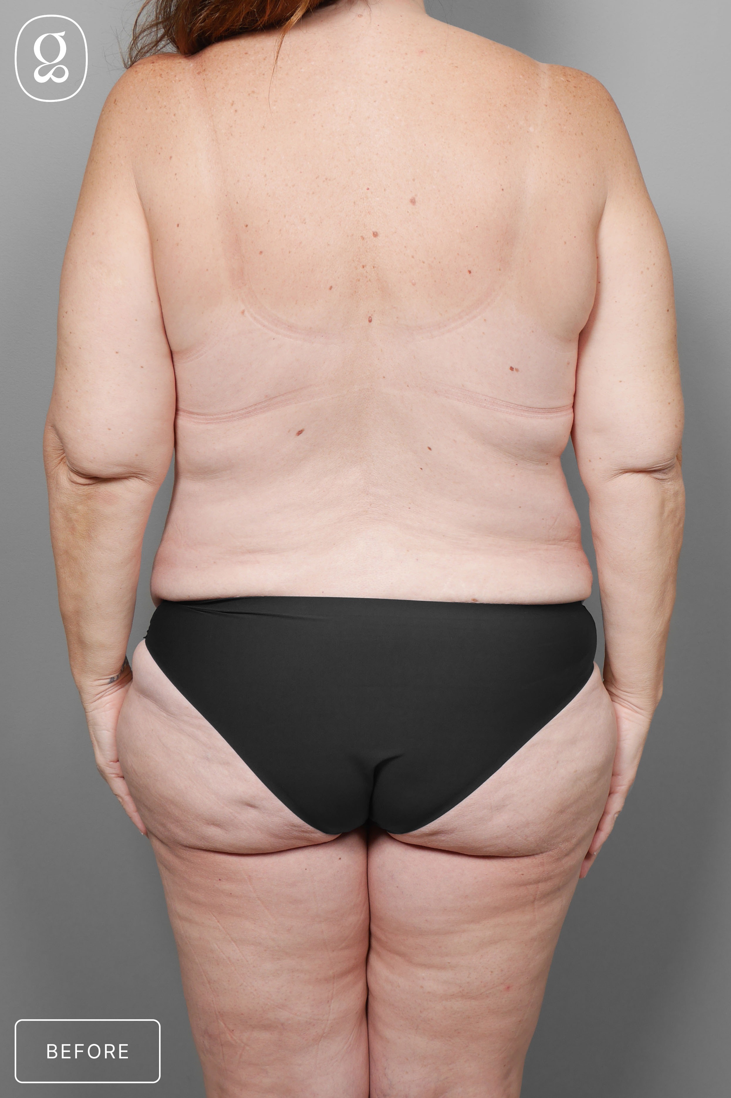 Body Contouring before photo
