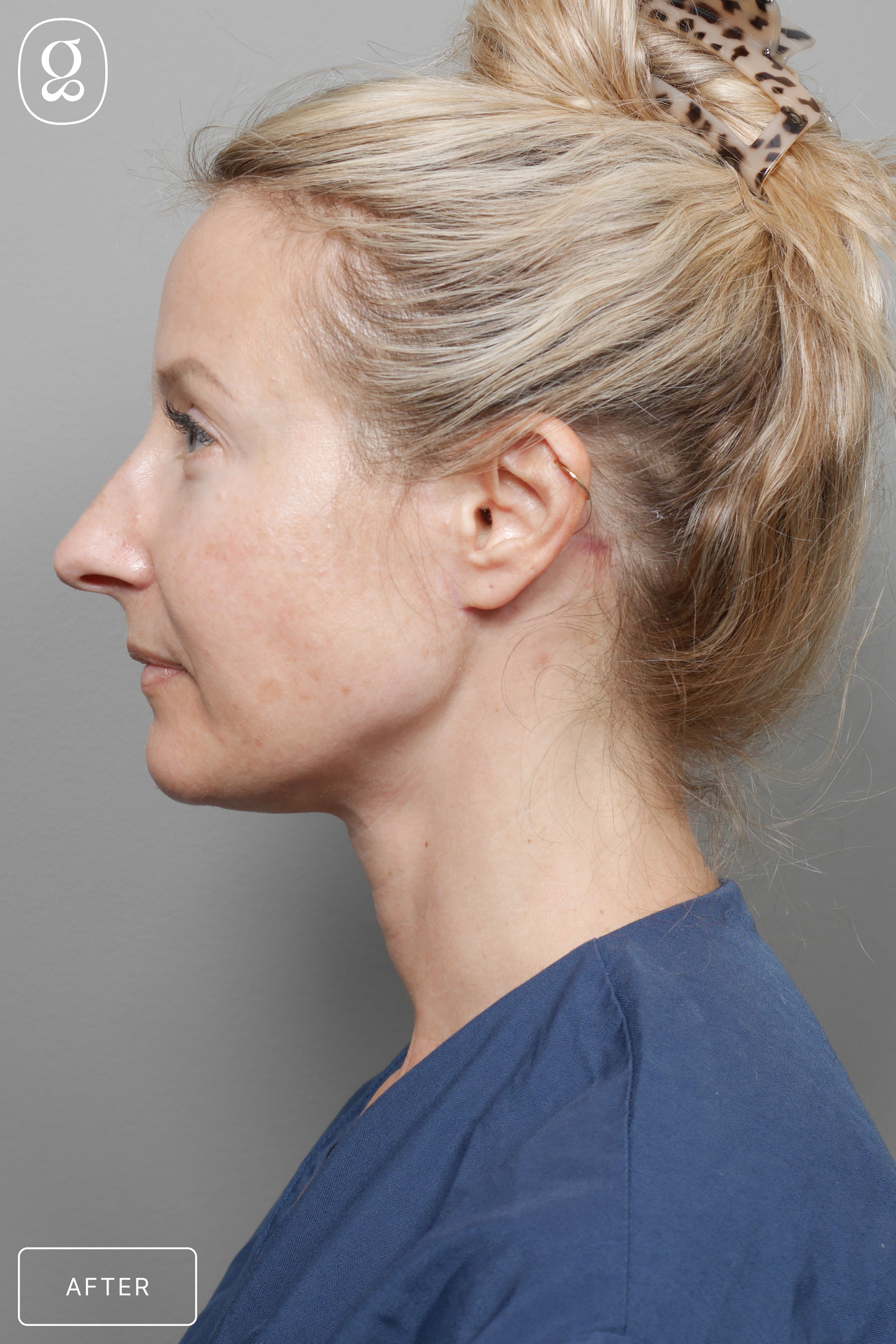 Neck Lift result at Gould Aesthetics