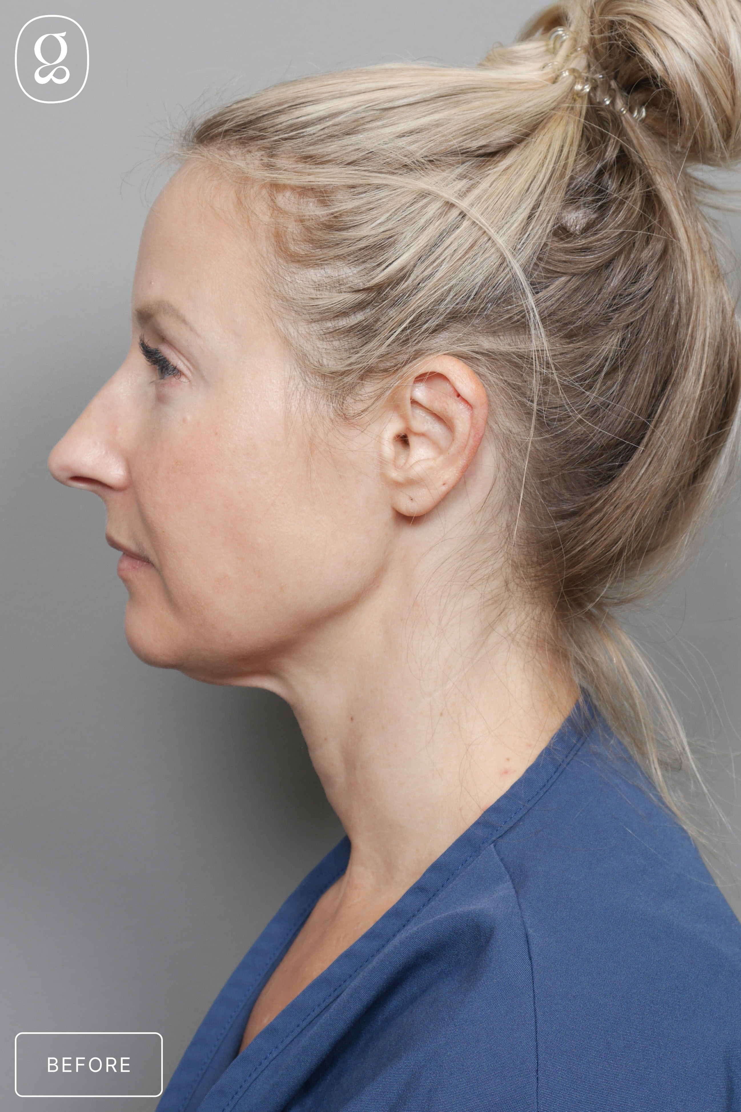 Neck Lift before photo