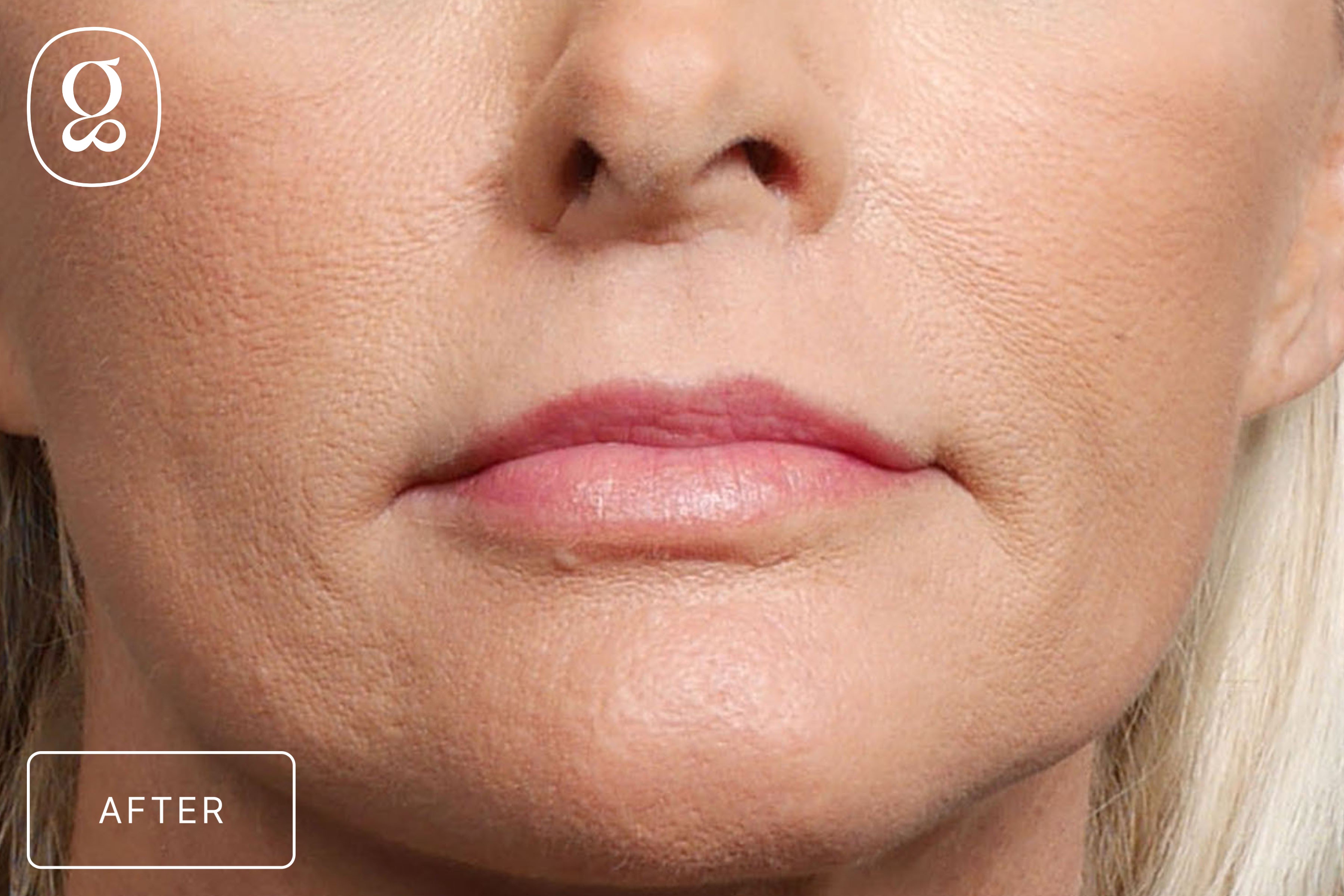 Lip Lift result at Gould Aesthetics