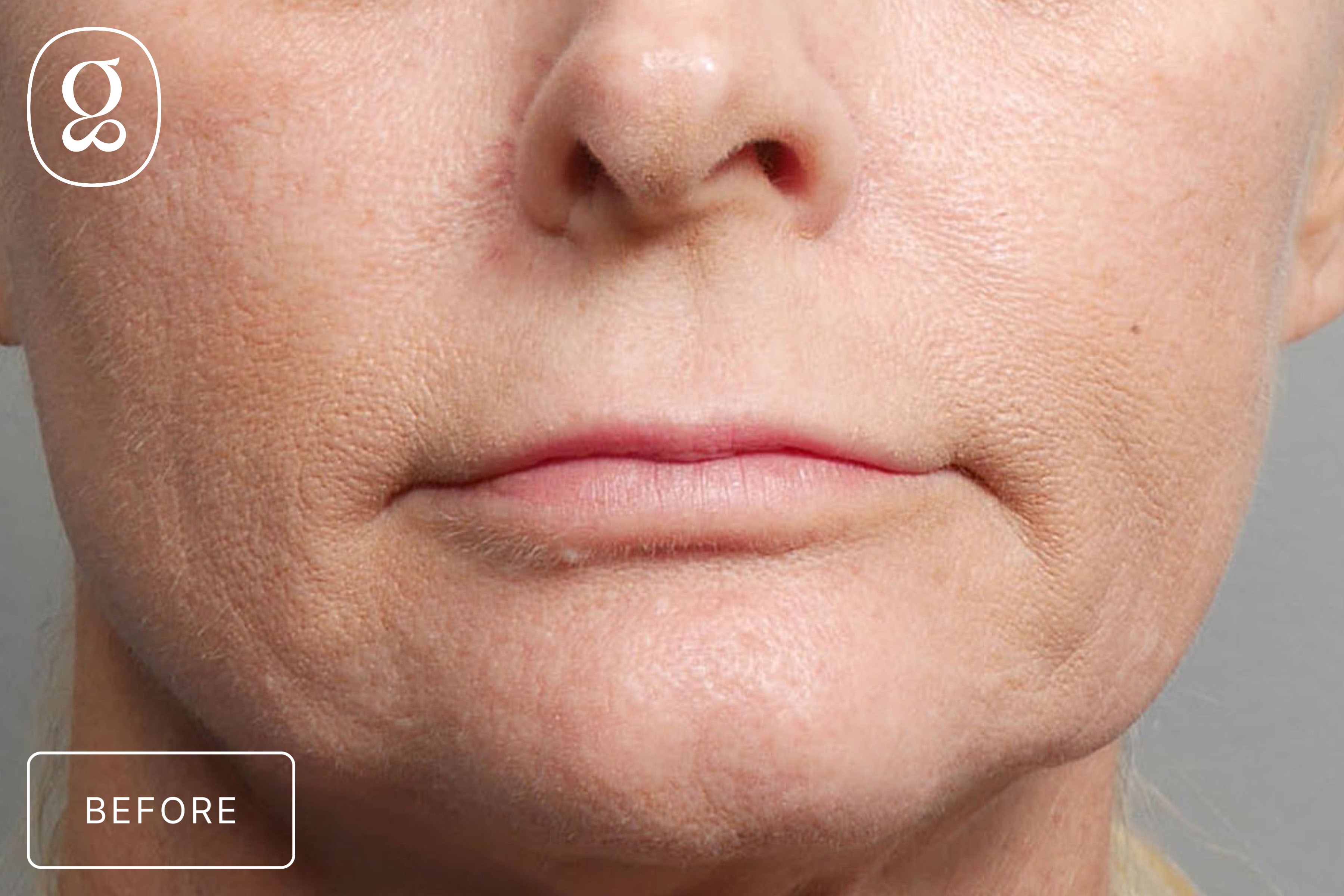 Lip Lift before photo
