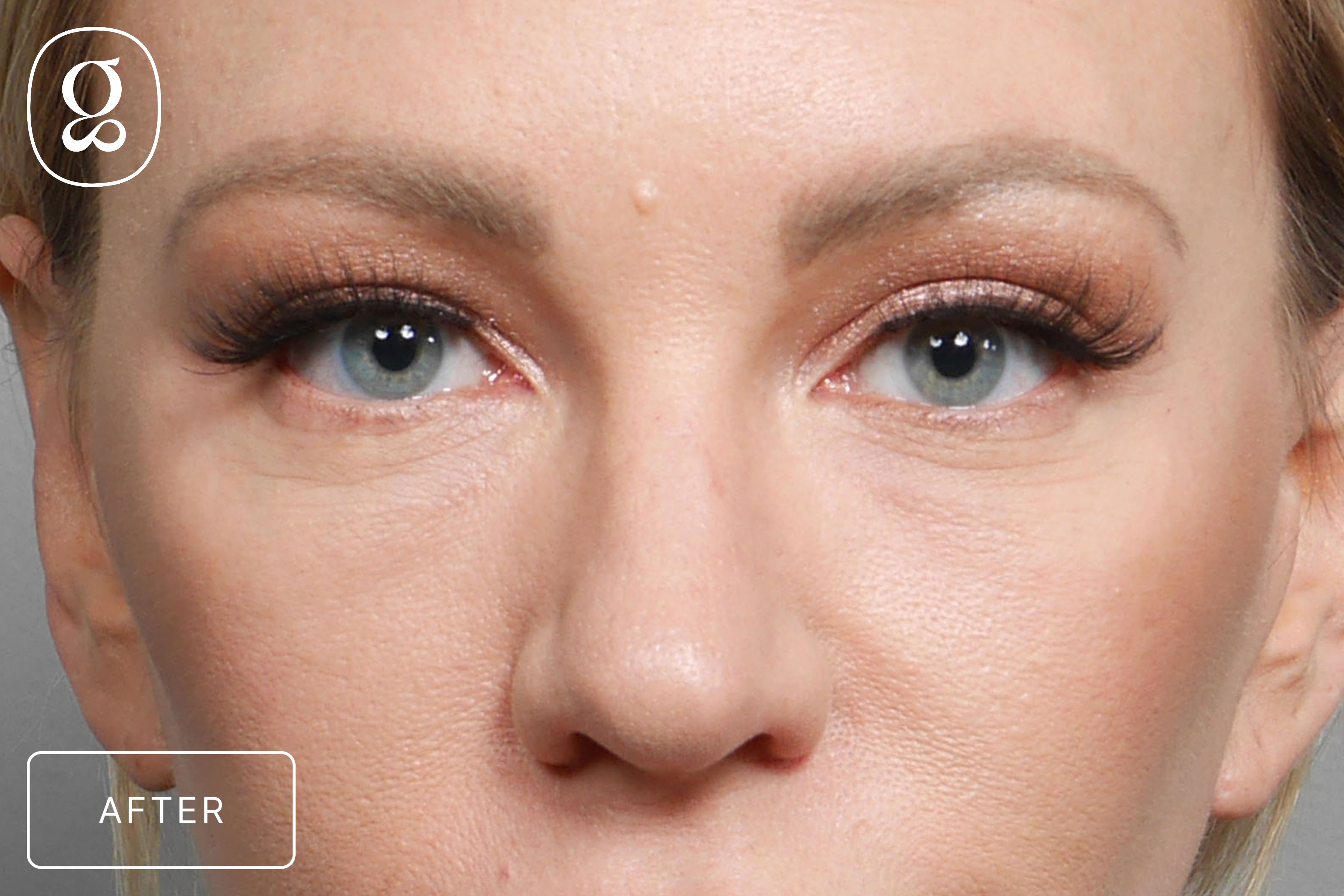 Blepharoplasty result at Gould Aesthetics