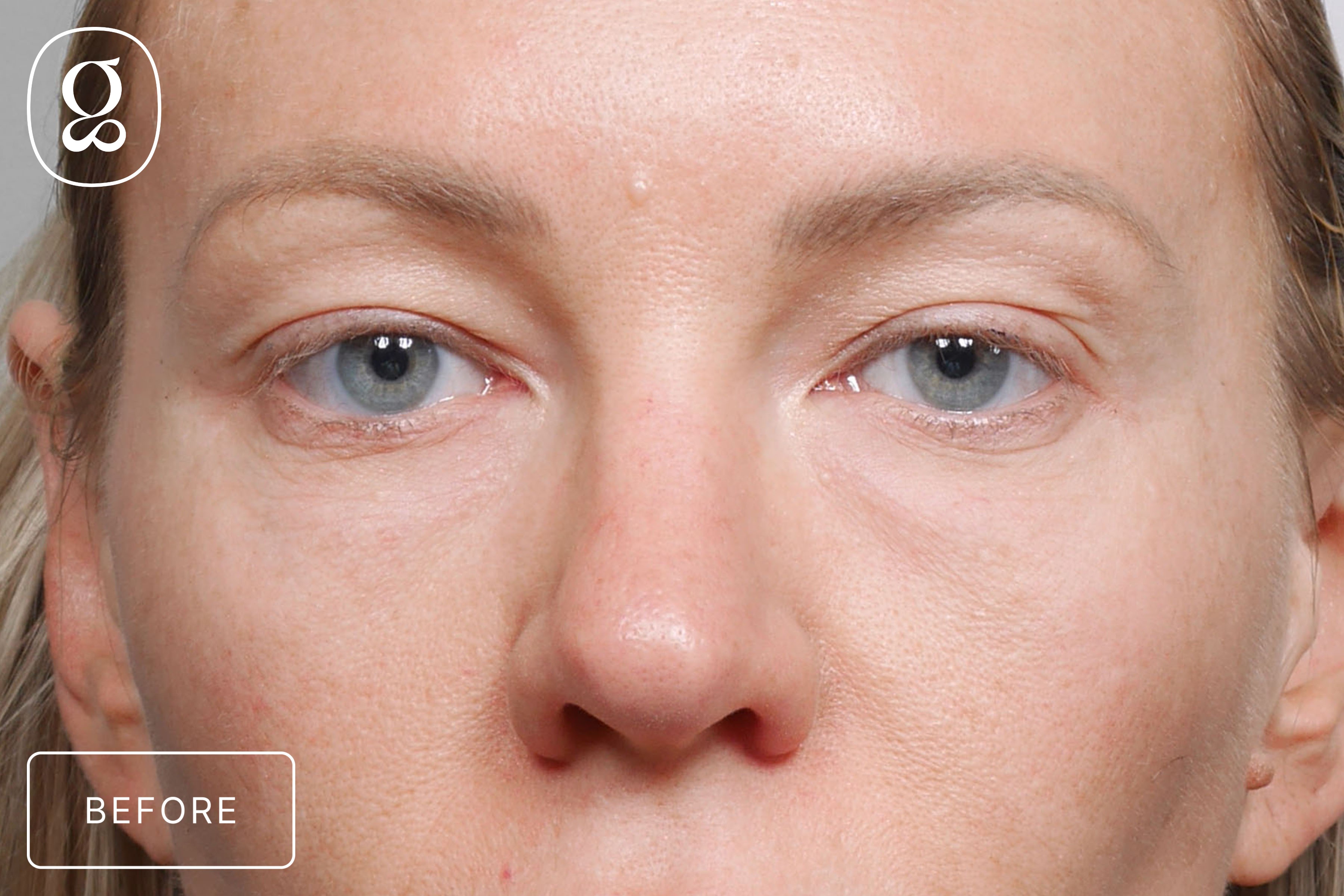 Blepharoplasty before photo