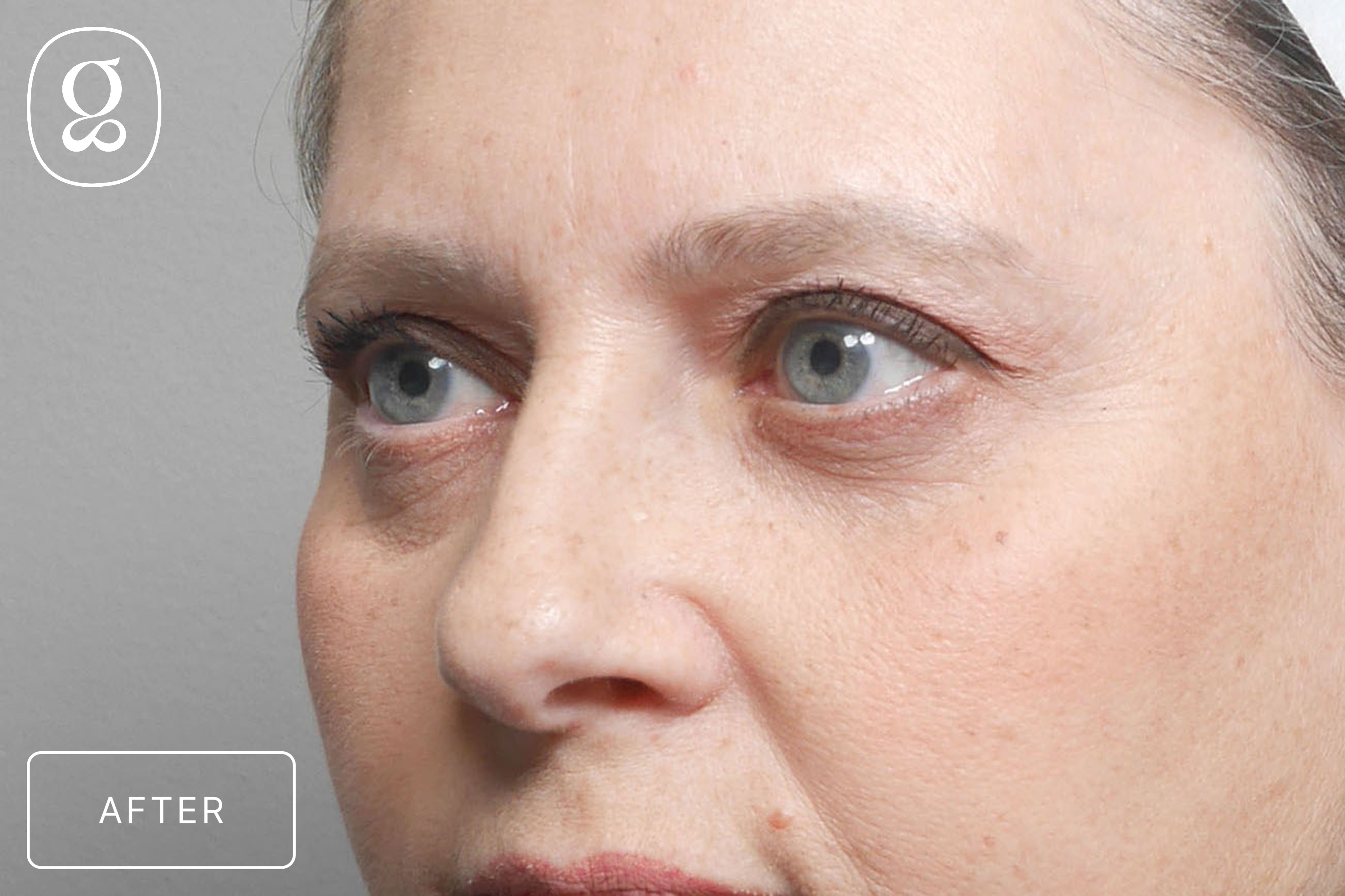 Brow Lift result at Gould Aesthetics
