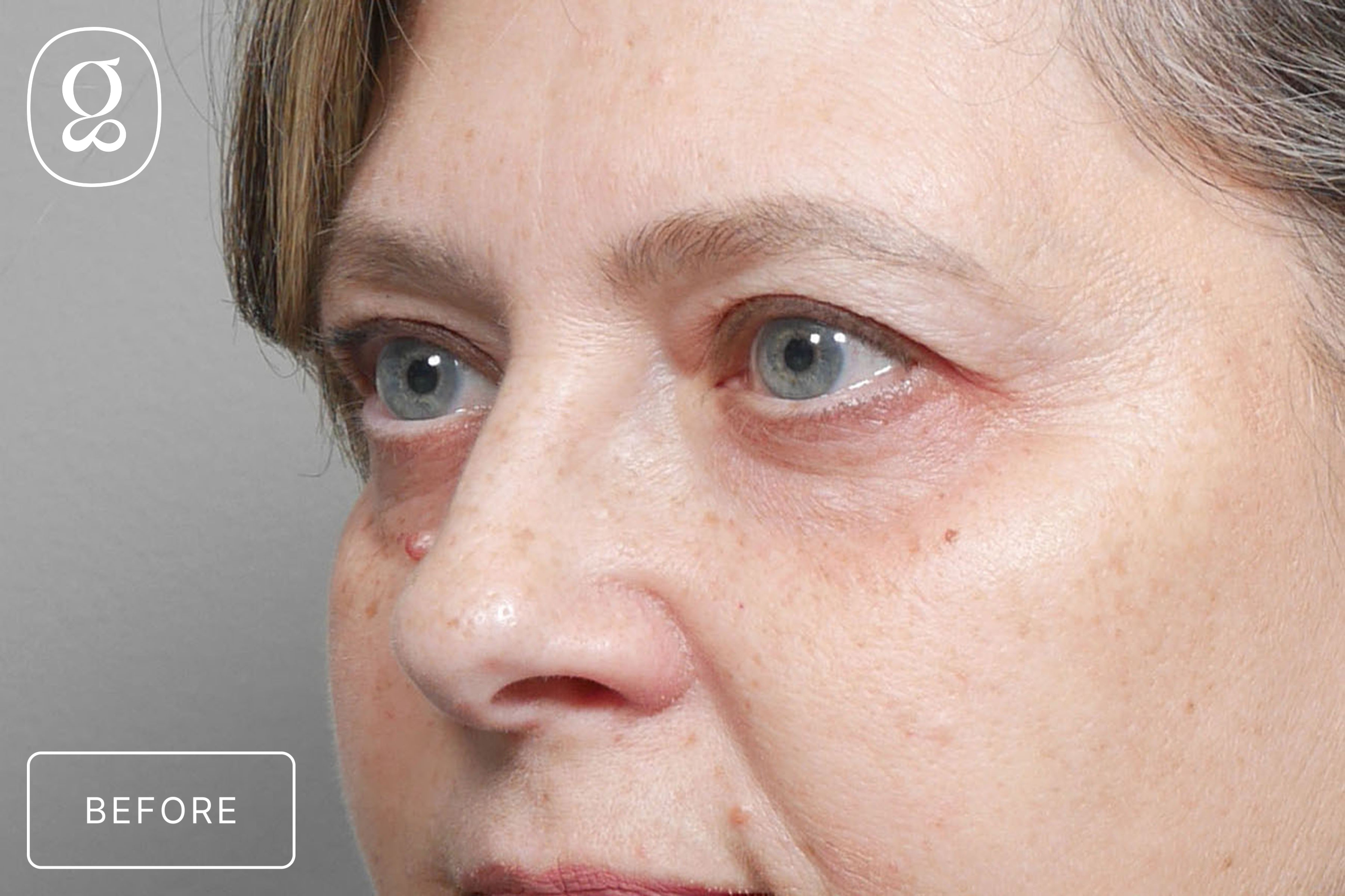 Brow Lift before photo