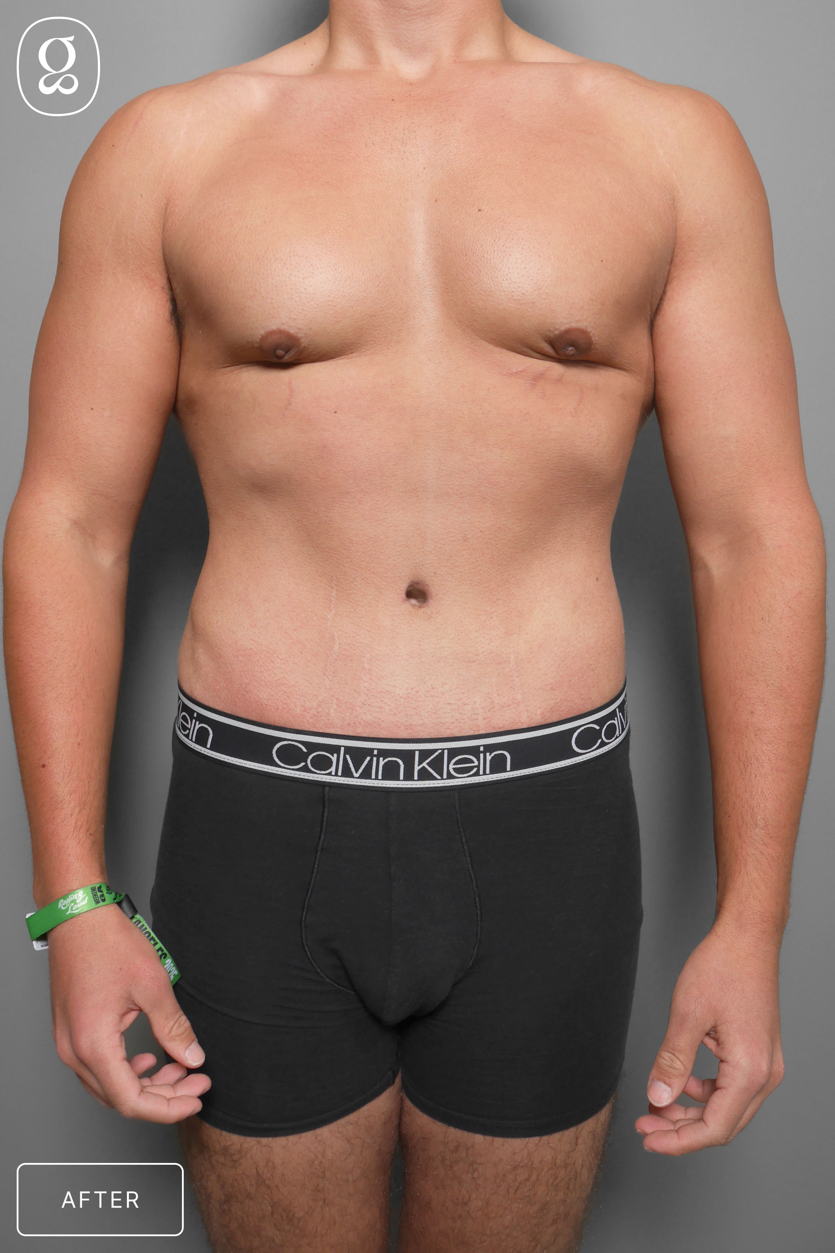 Gynecomastia result at Gould Aesthetics