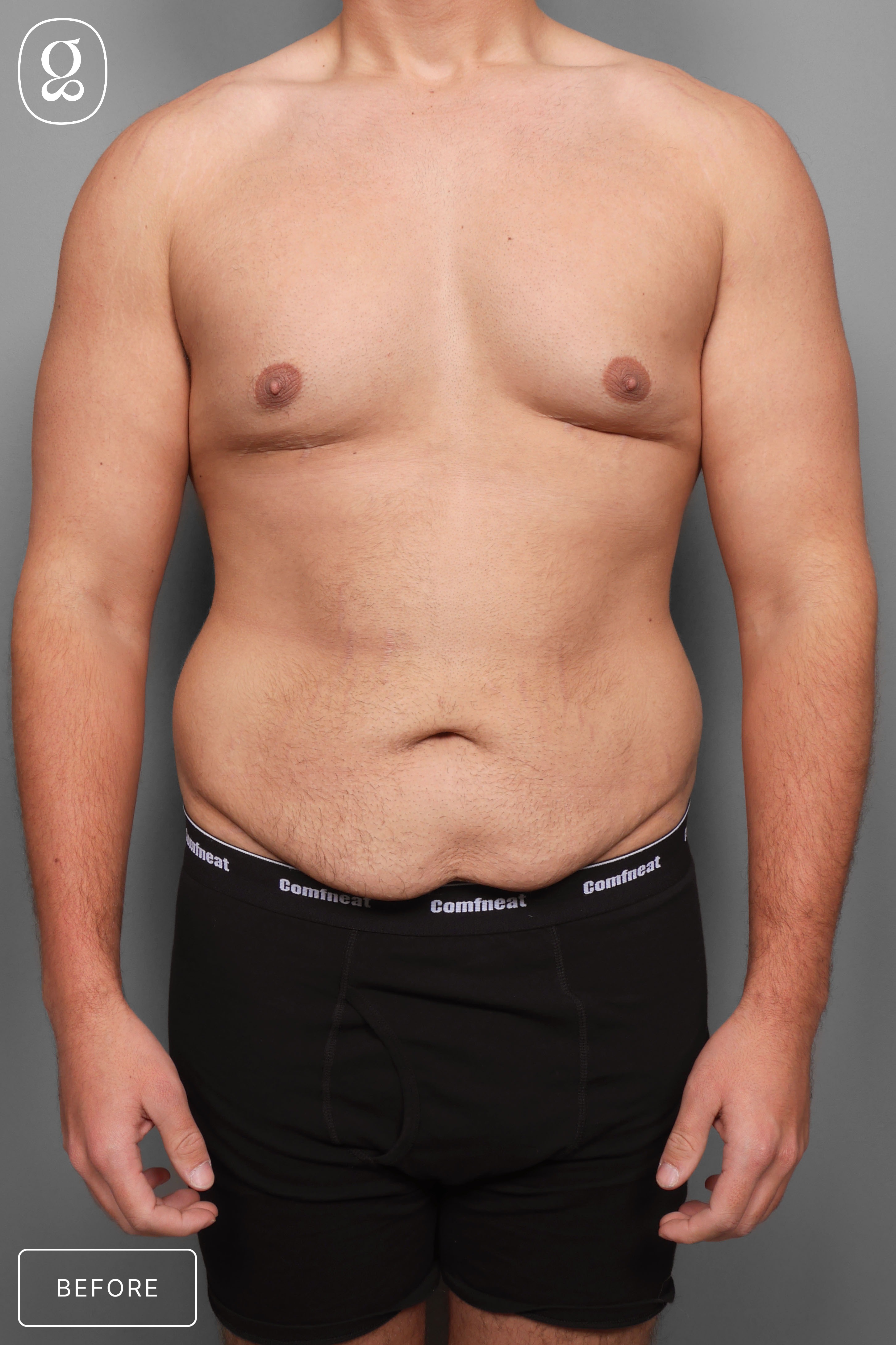 Gynecomastia before photo