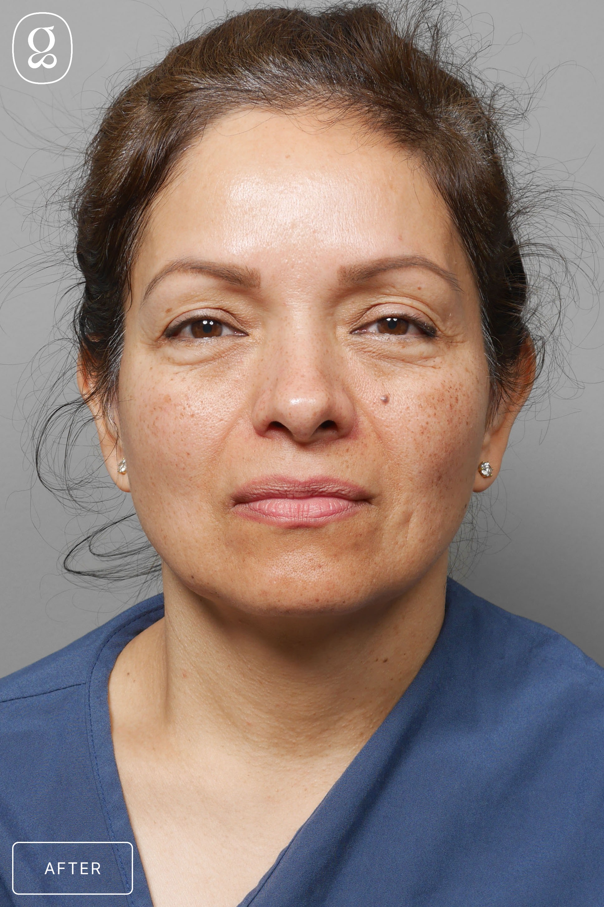Otoplasty result at Gould Aesthetics