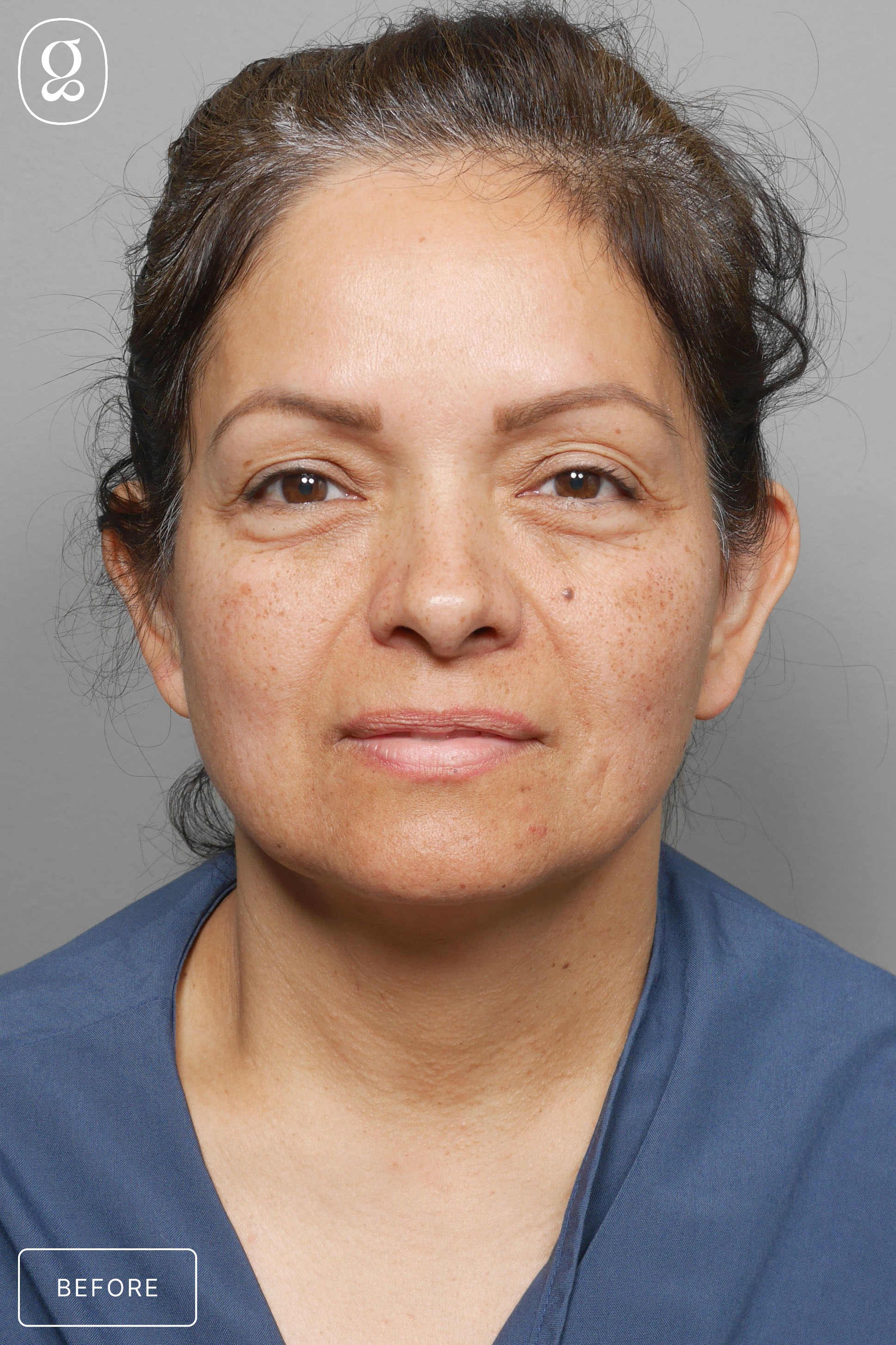 Otoplasty before photo
