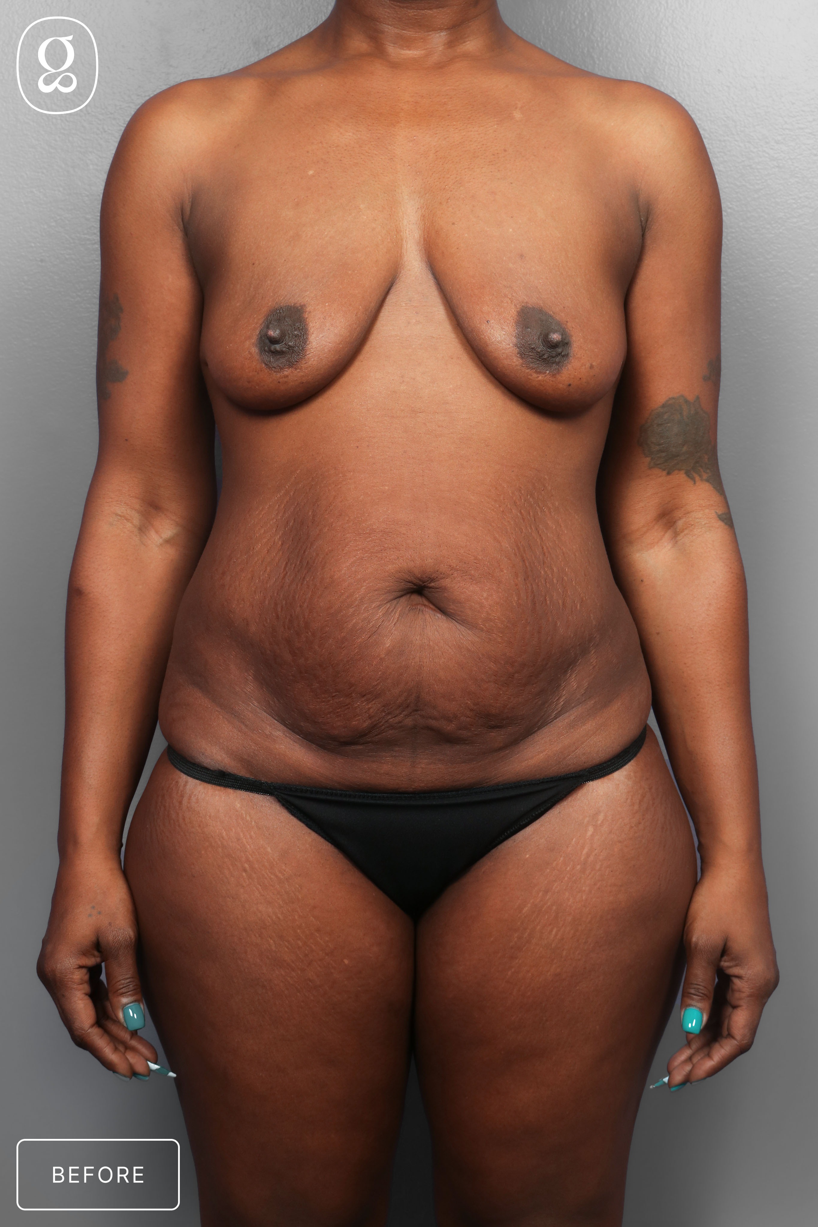 Tummy Tuck before photo
