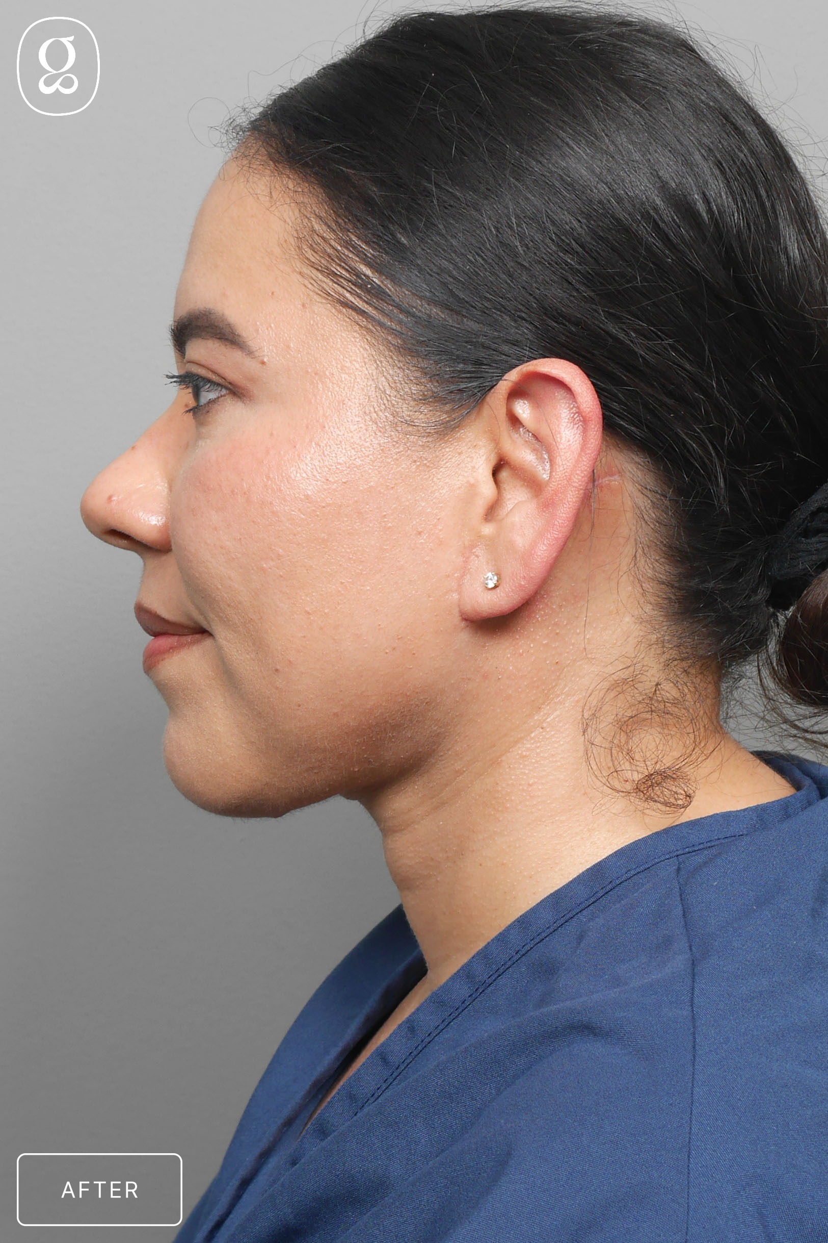 Neck Lift result at Gould Aesthetics