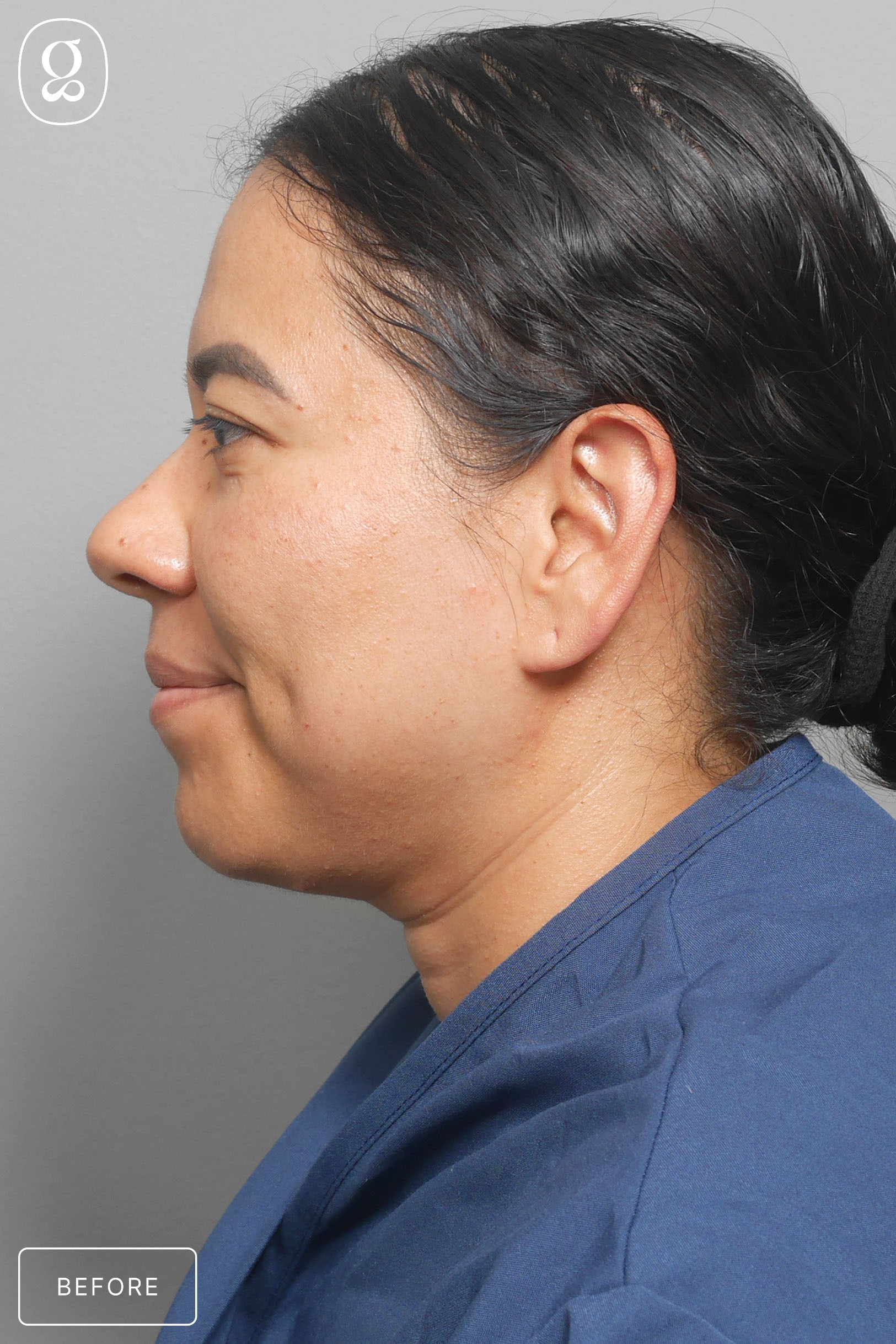 Neck Lift before photo